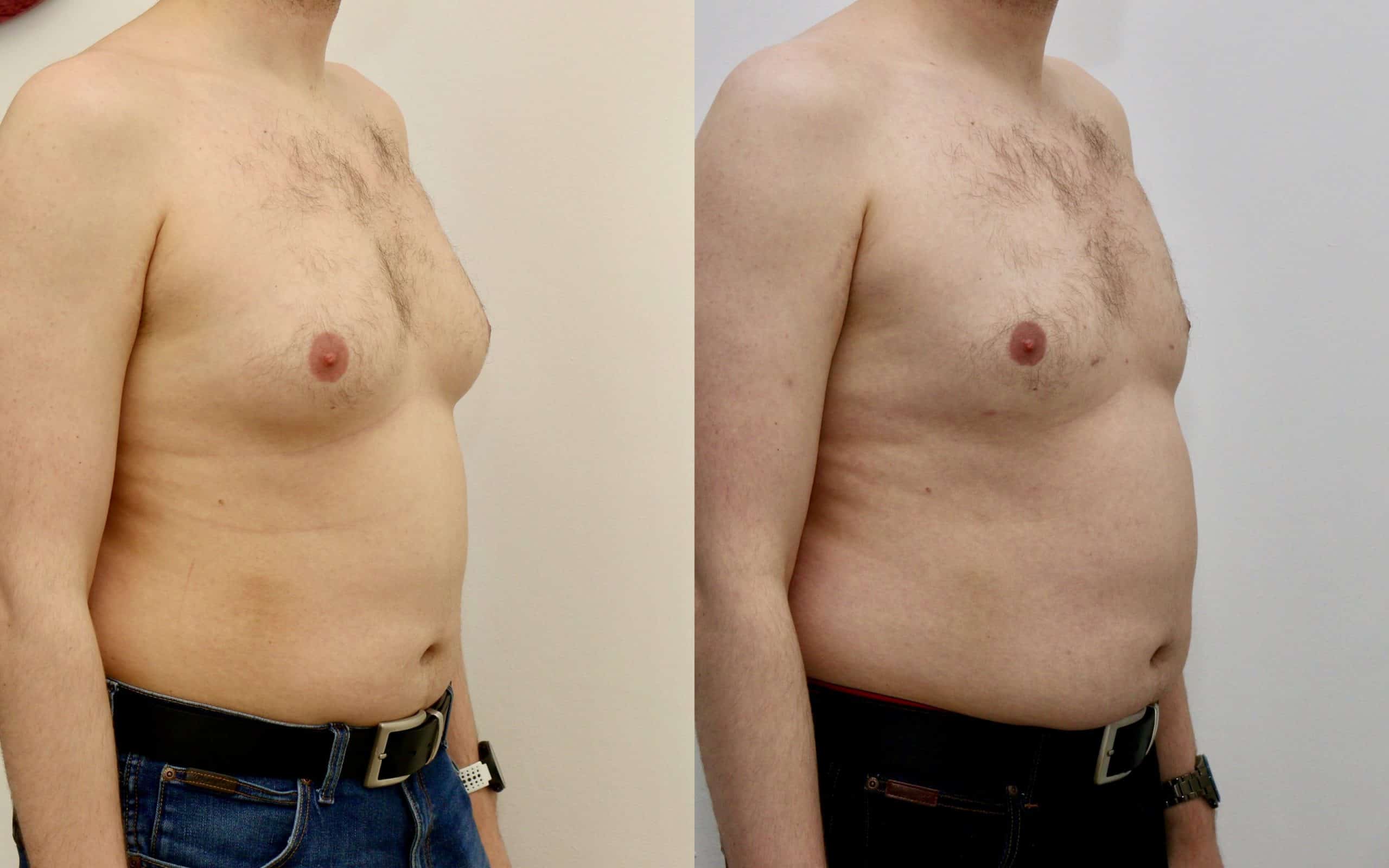 Gynecomastia liposuction before and after