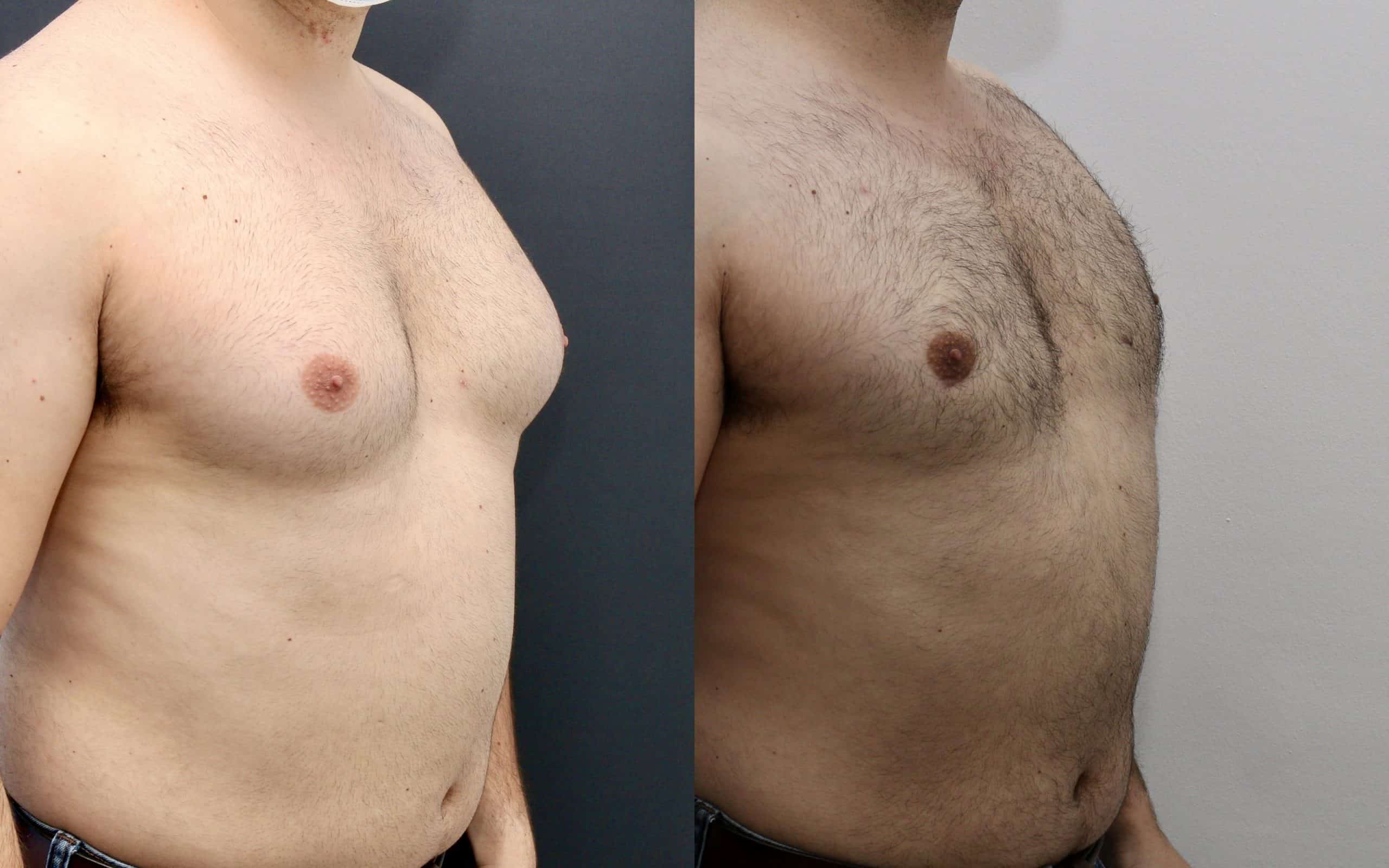 Male breast reduction before and after