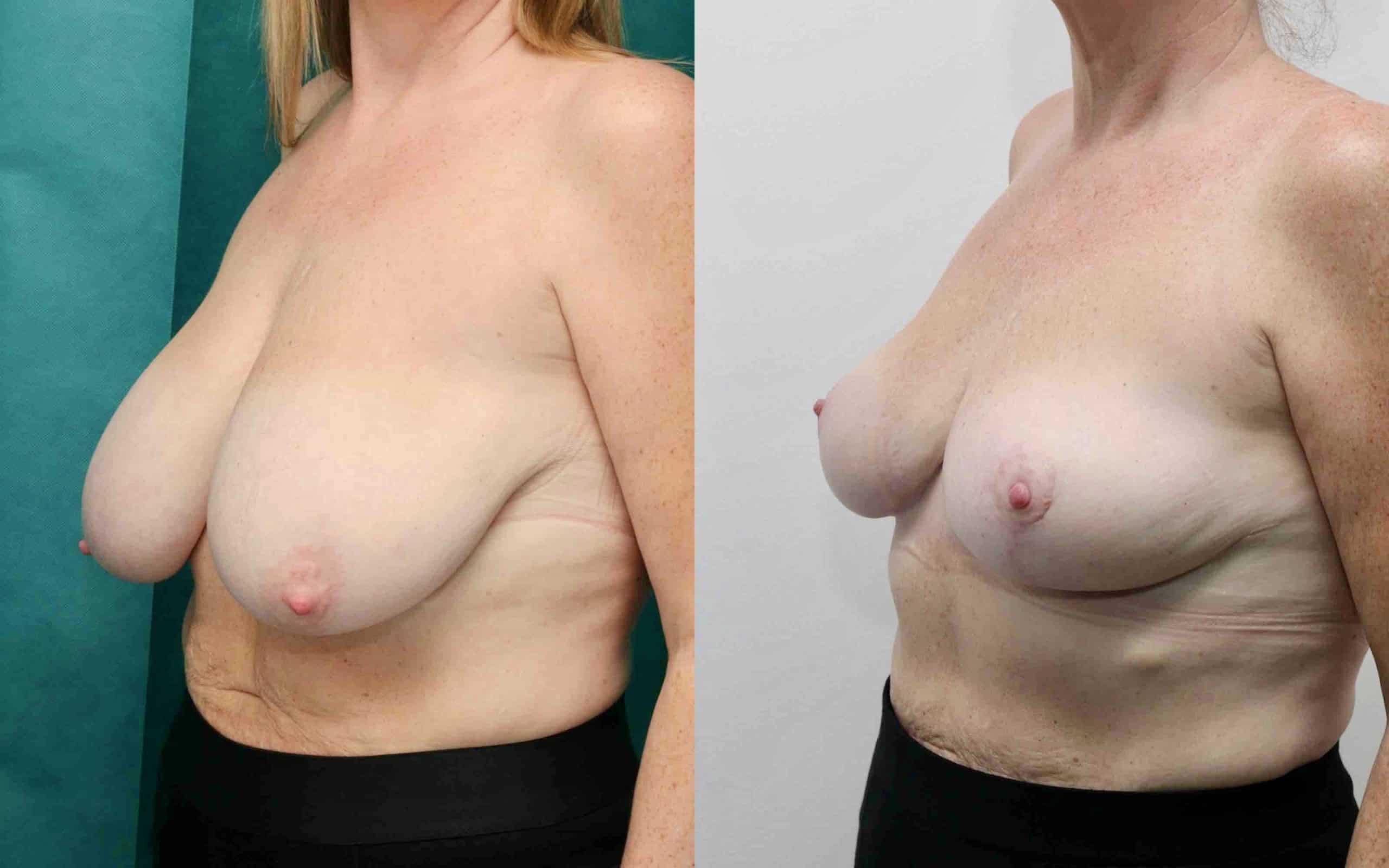 Breast reduction