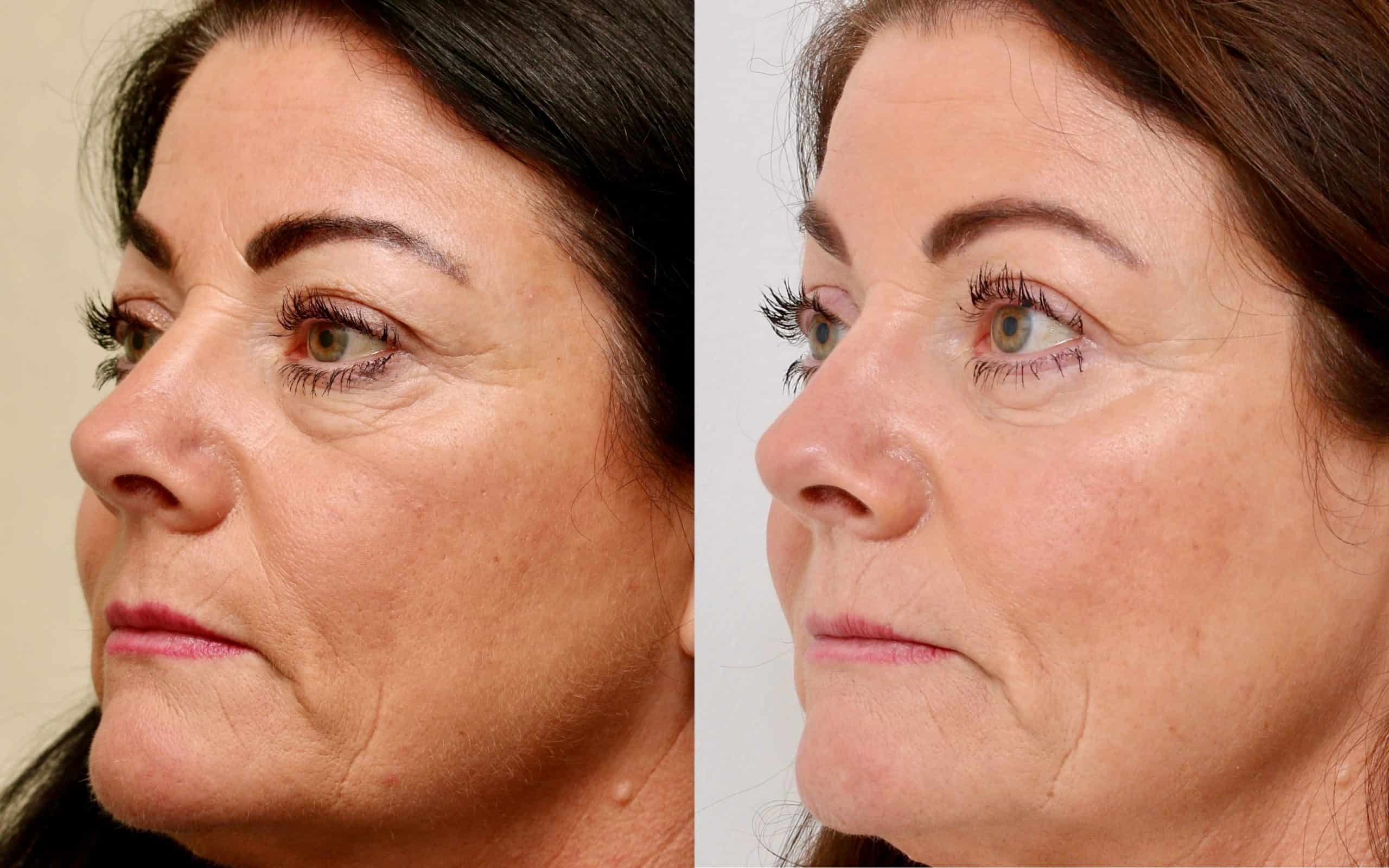 Eyelid surgery with fat transfer