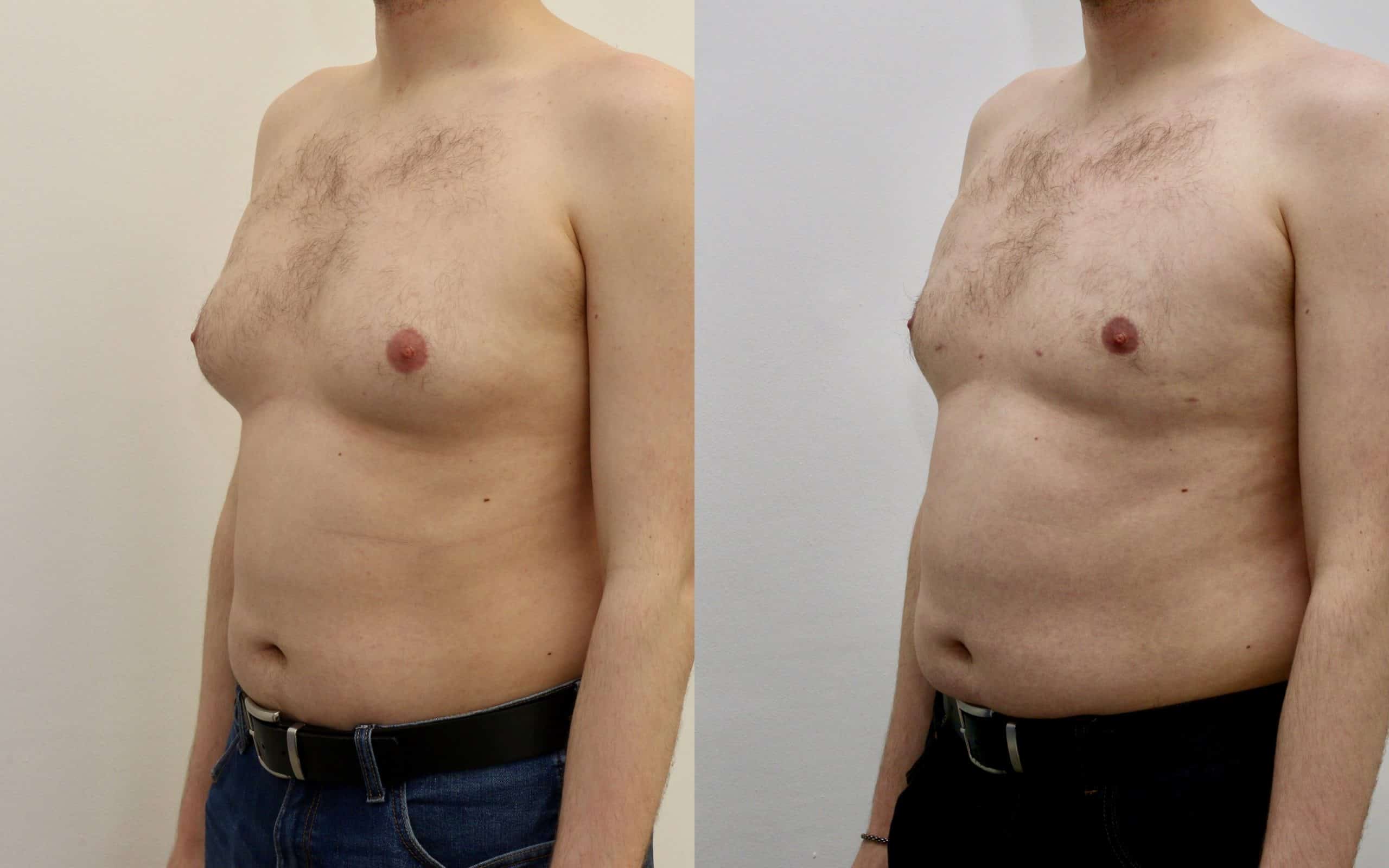 Gynecomastia liposuction before and after