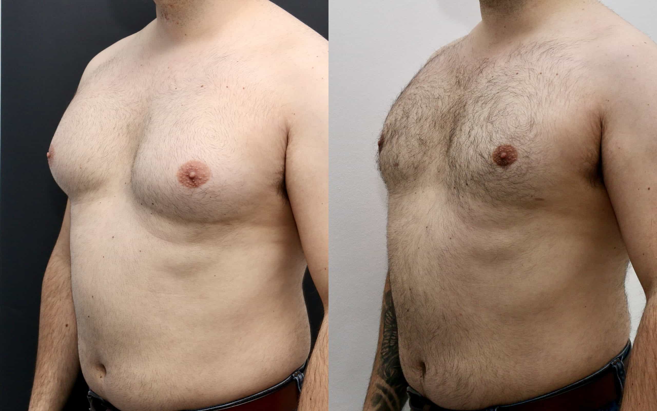 Male breast reduction before and after