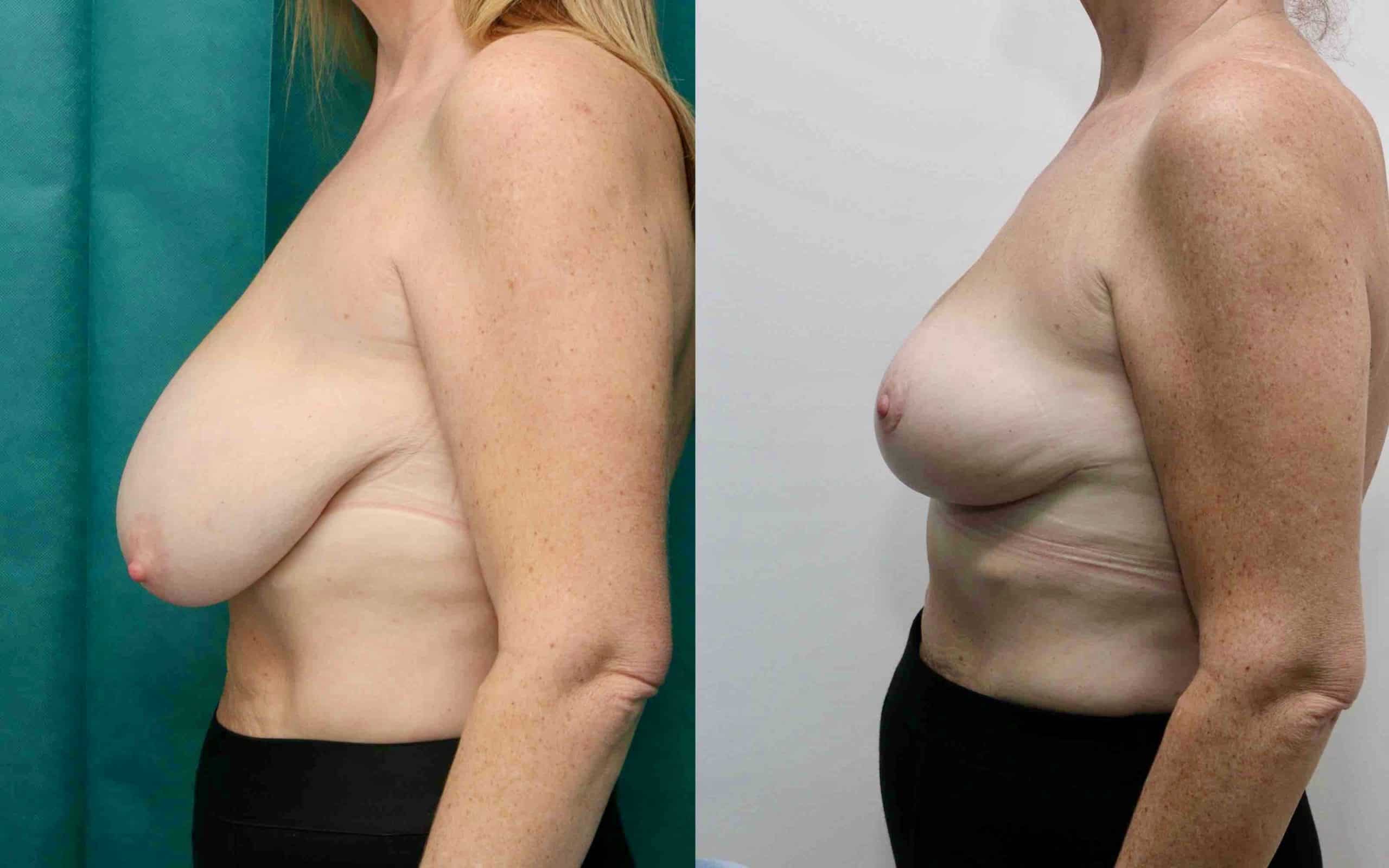 Breast reduction