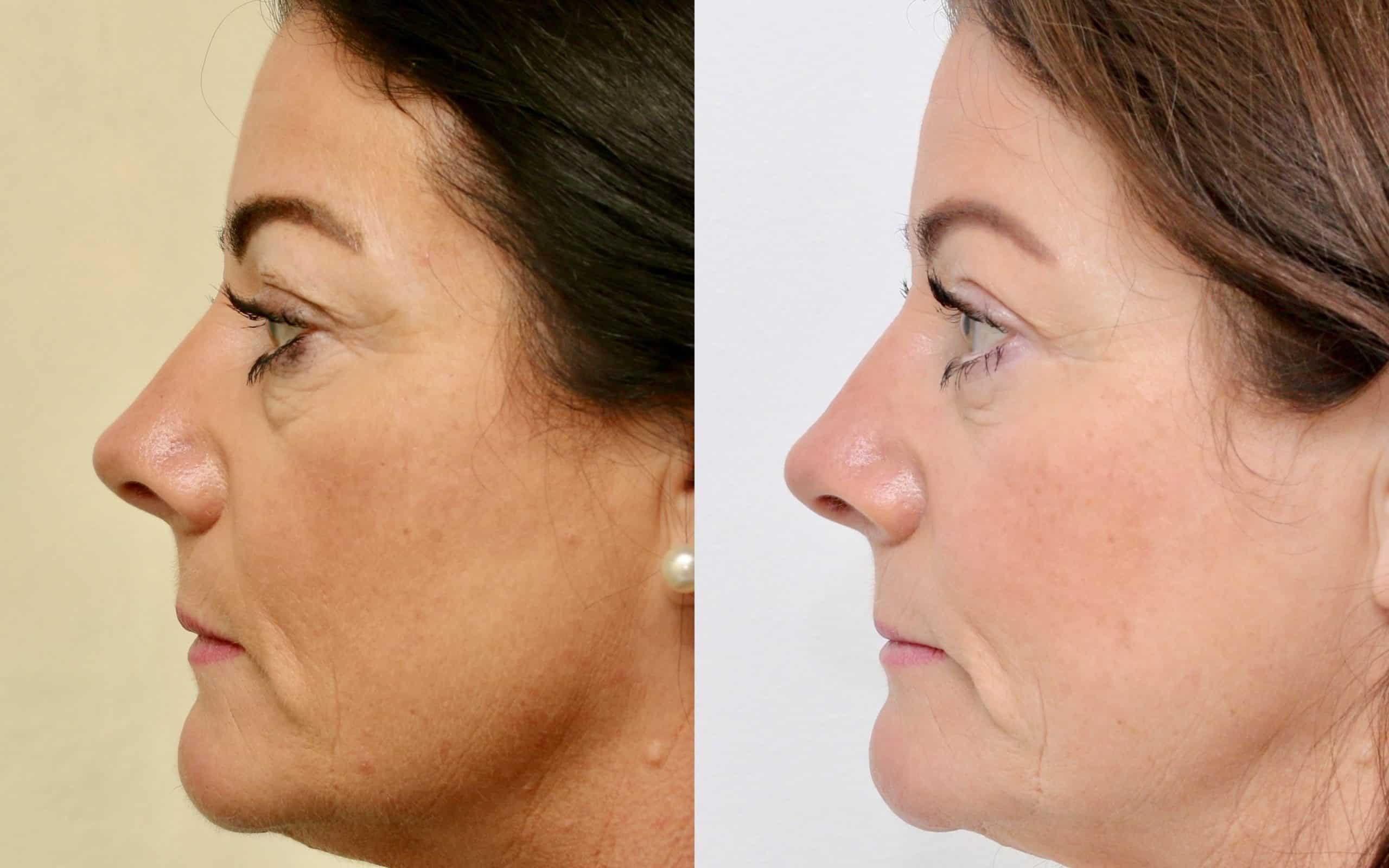 Eyelid surgery with fat transfer