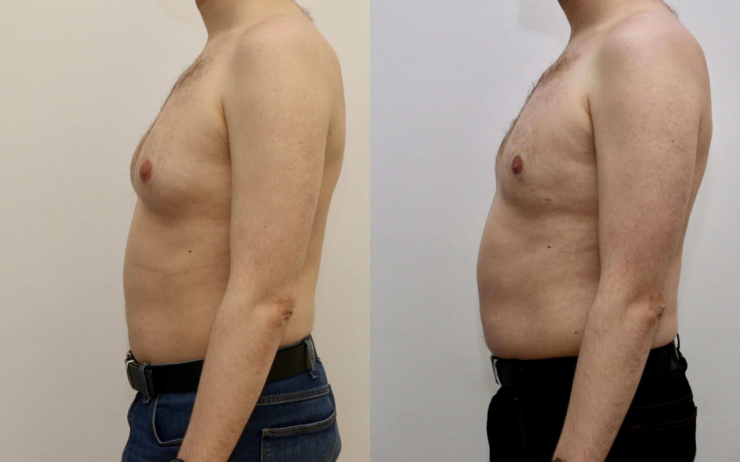 Gynecomastia liposuction before and after