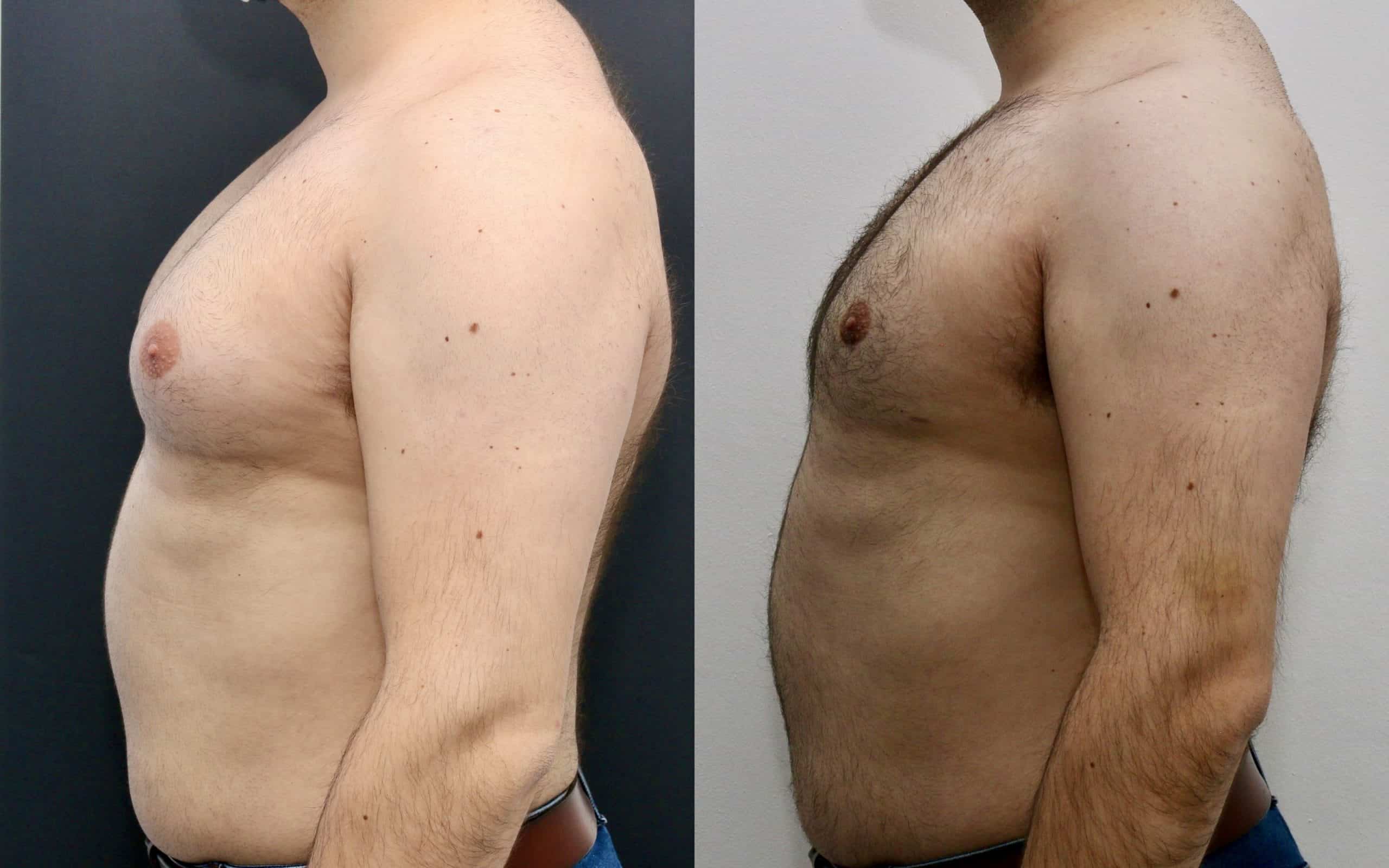 Male breast reduction before and after