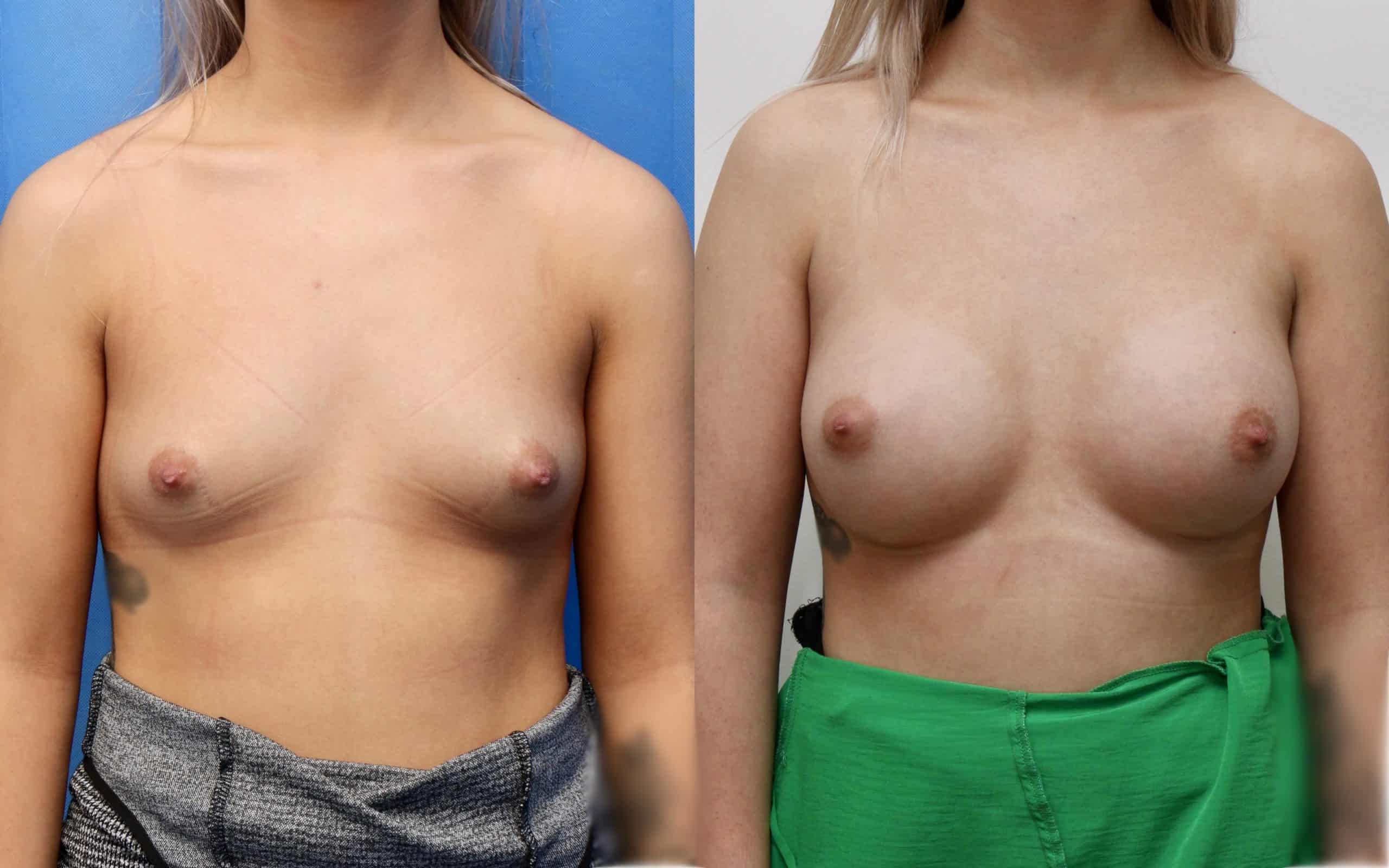 Breast implants 305cc