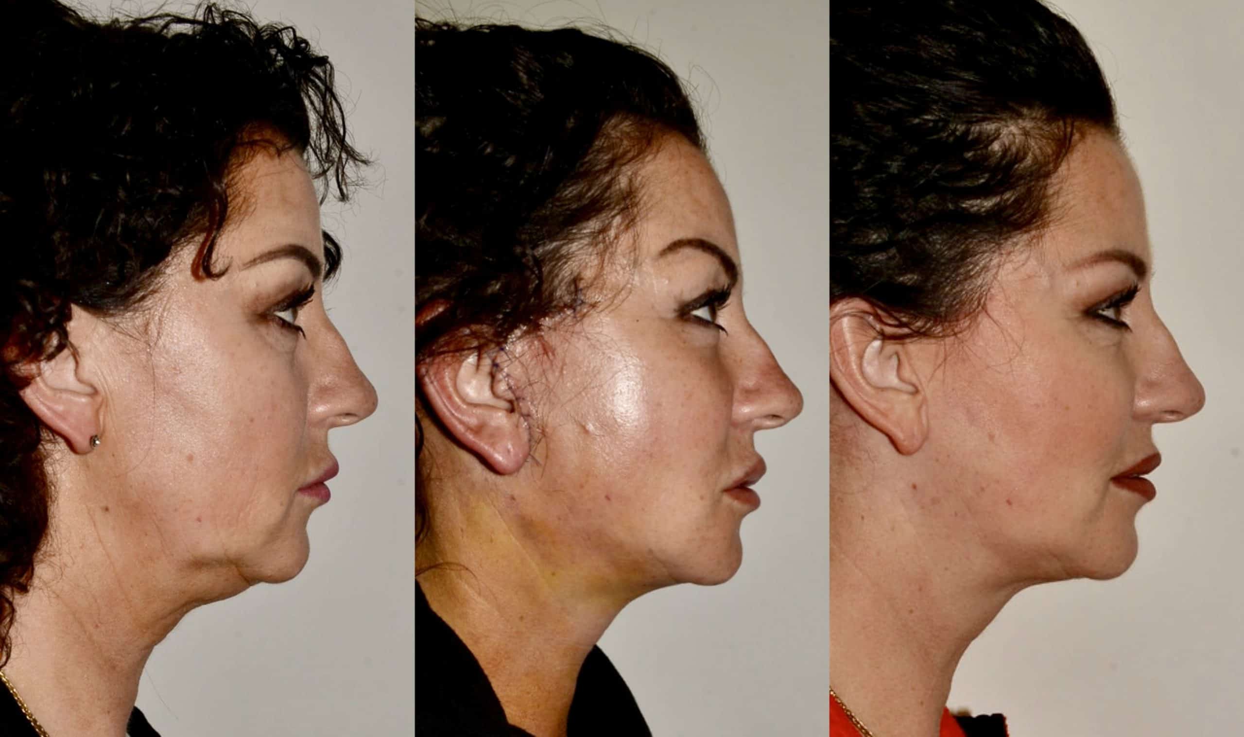 Lower face/ neck lift before, 7 days and 6 months post-op