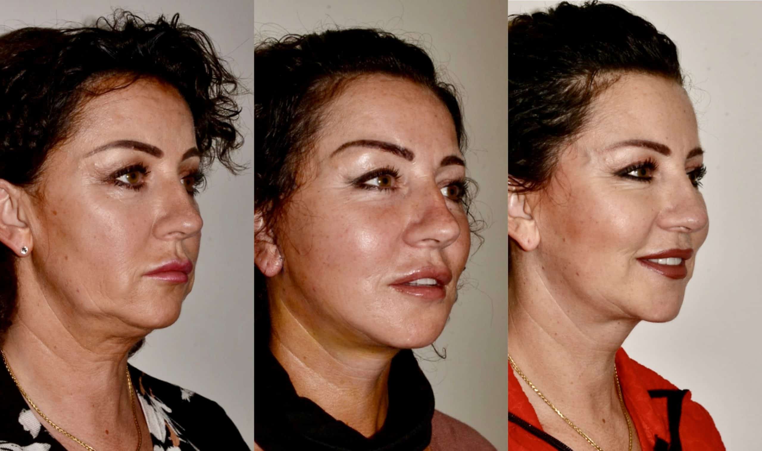 Lower face/ neck lift before, 7 days and 6 months post-op