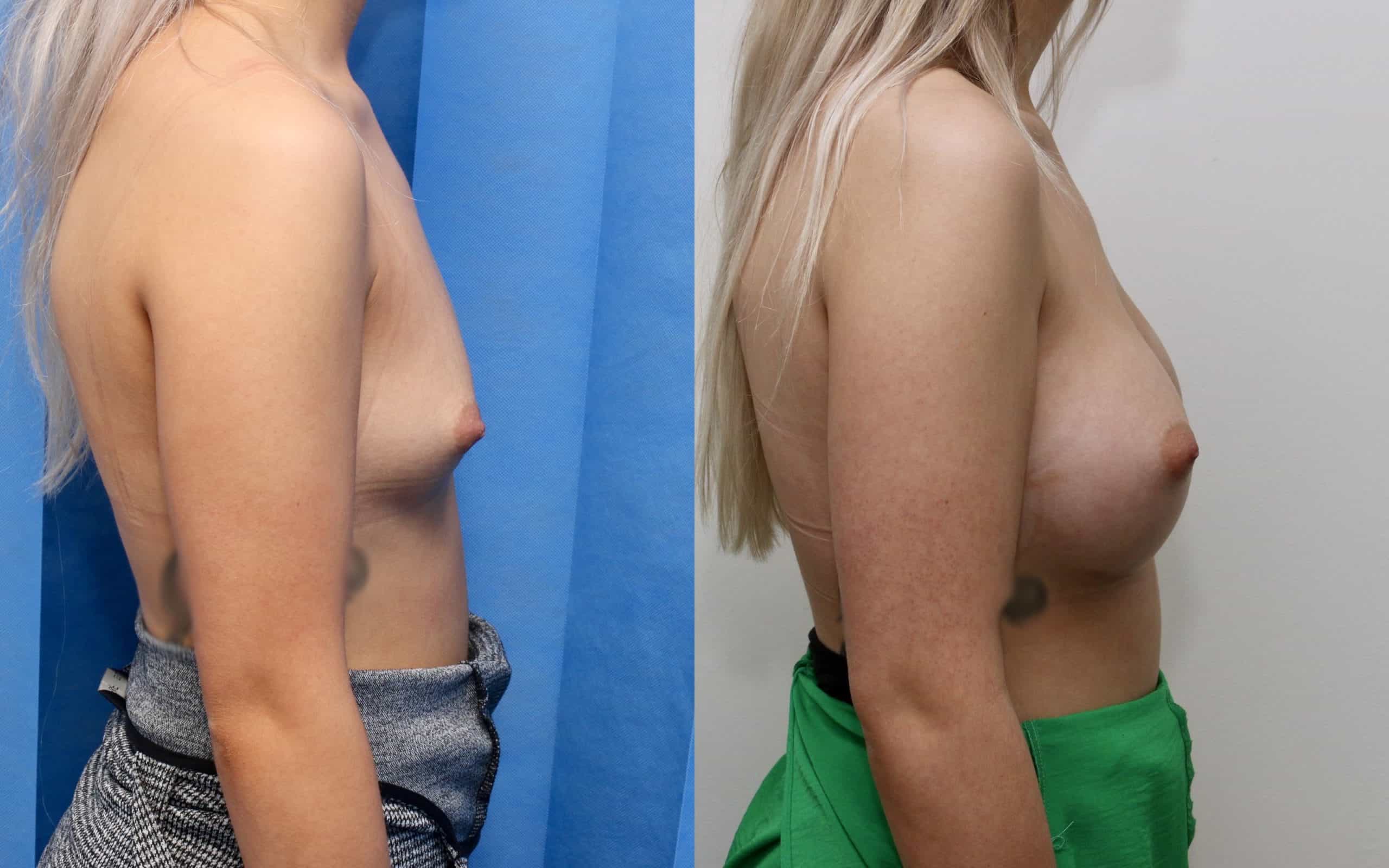 Breast implants 305cc