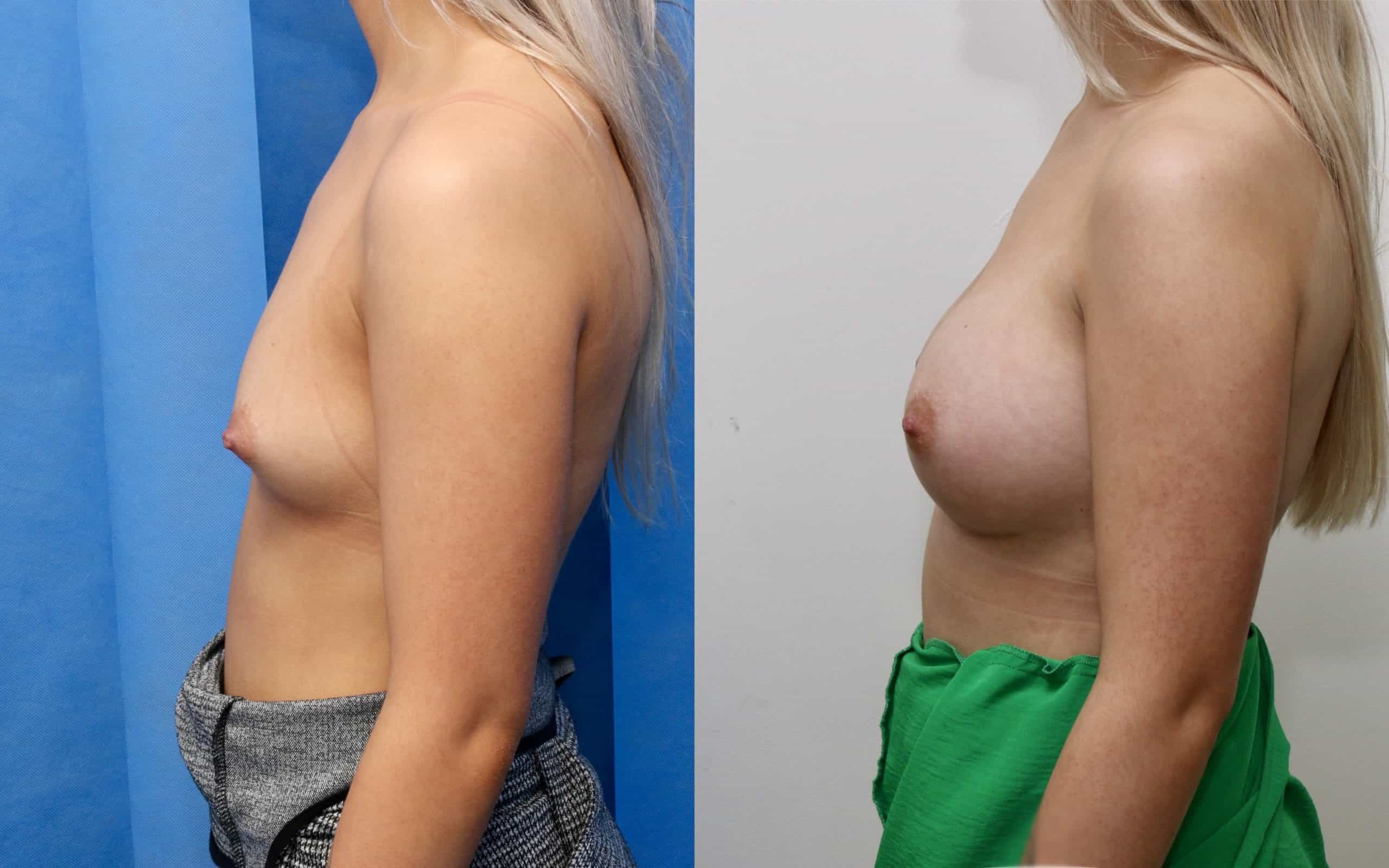 Breast implants 305cc