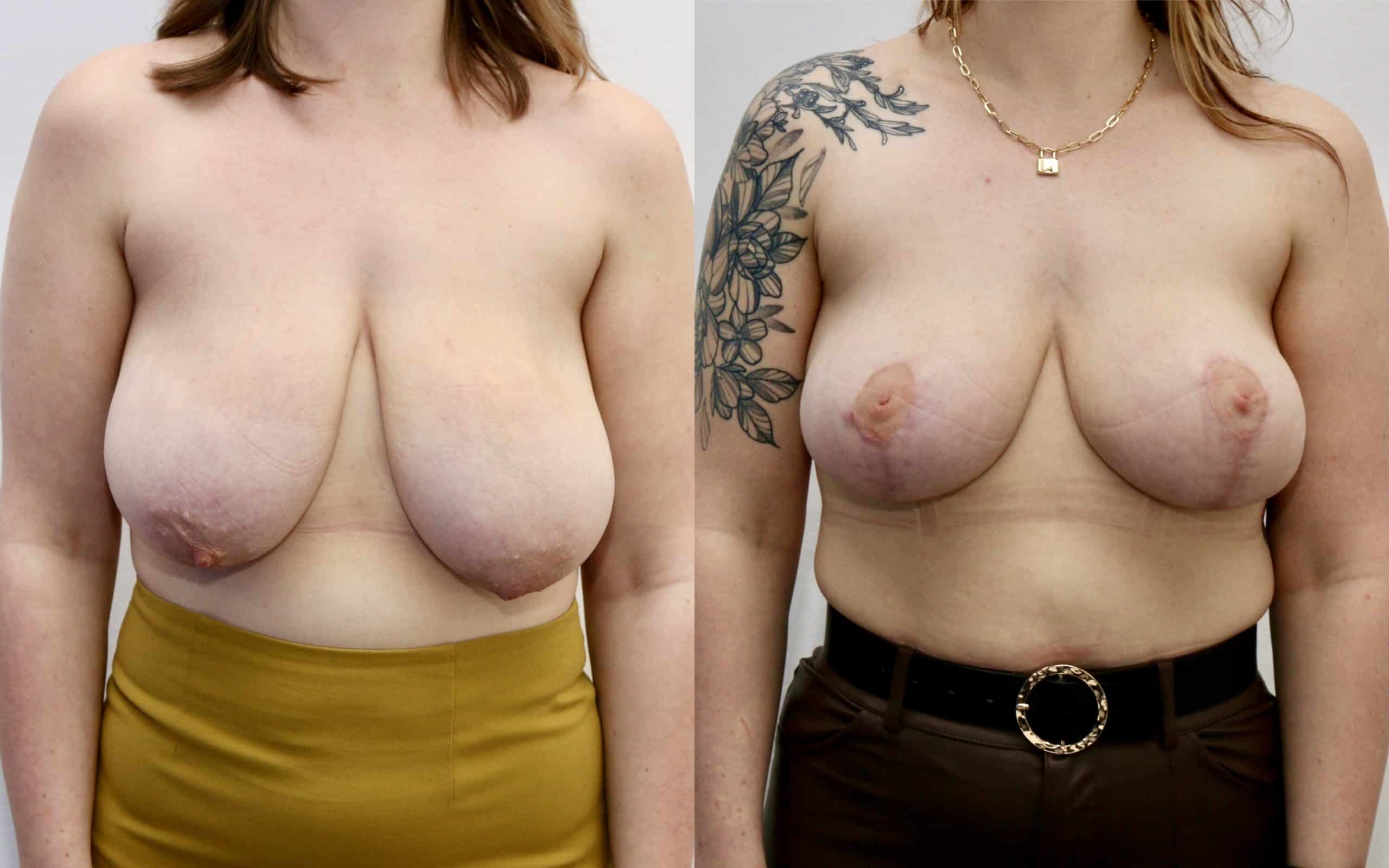 Breast lift