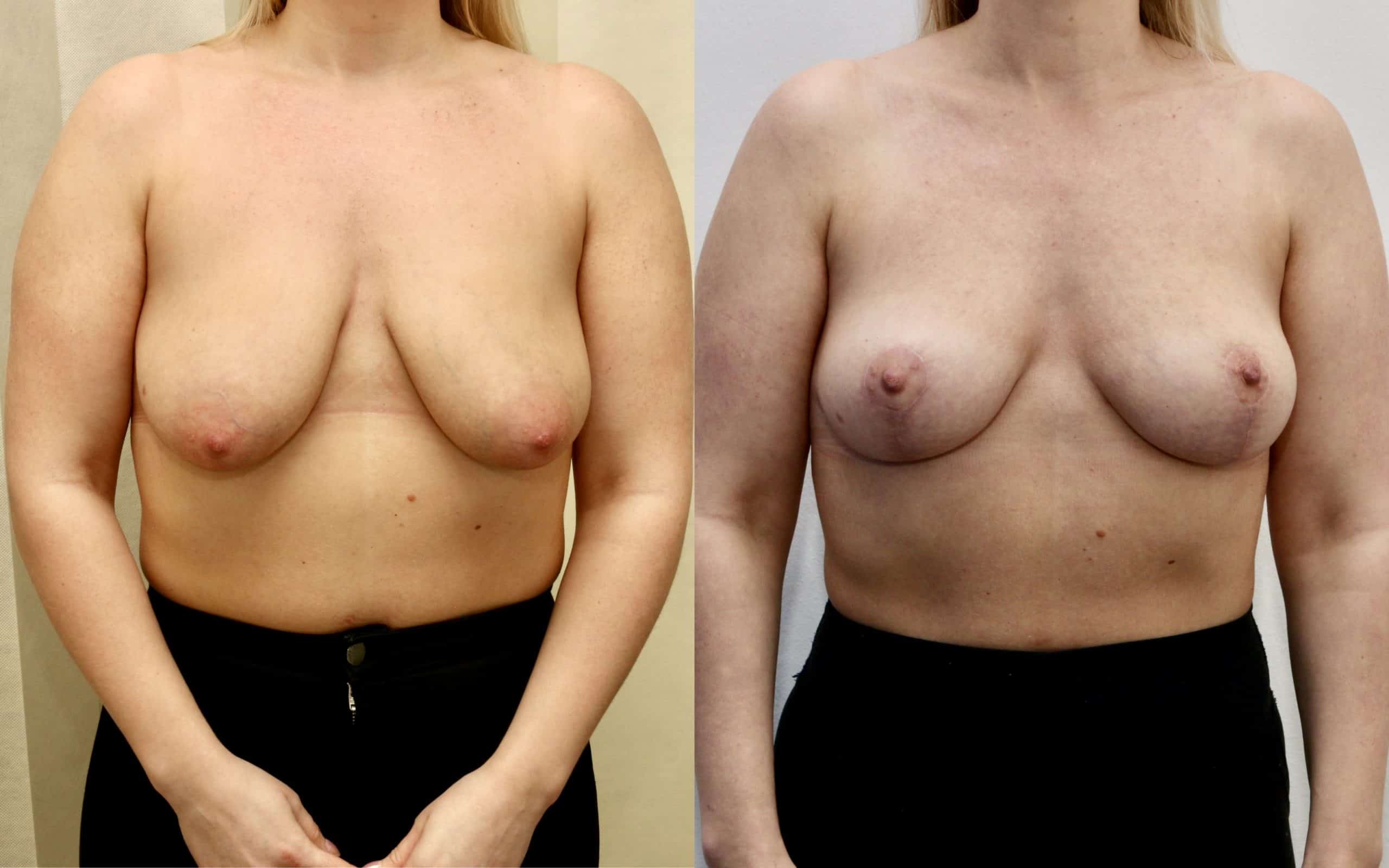 Breast lift (skin tightening only)
