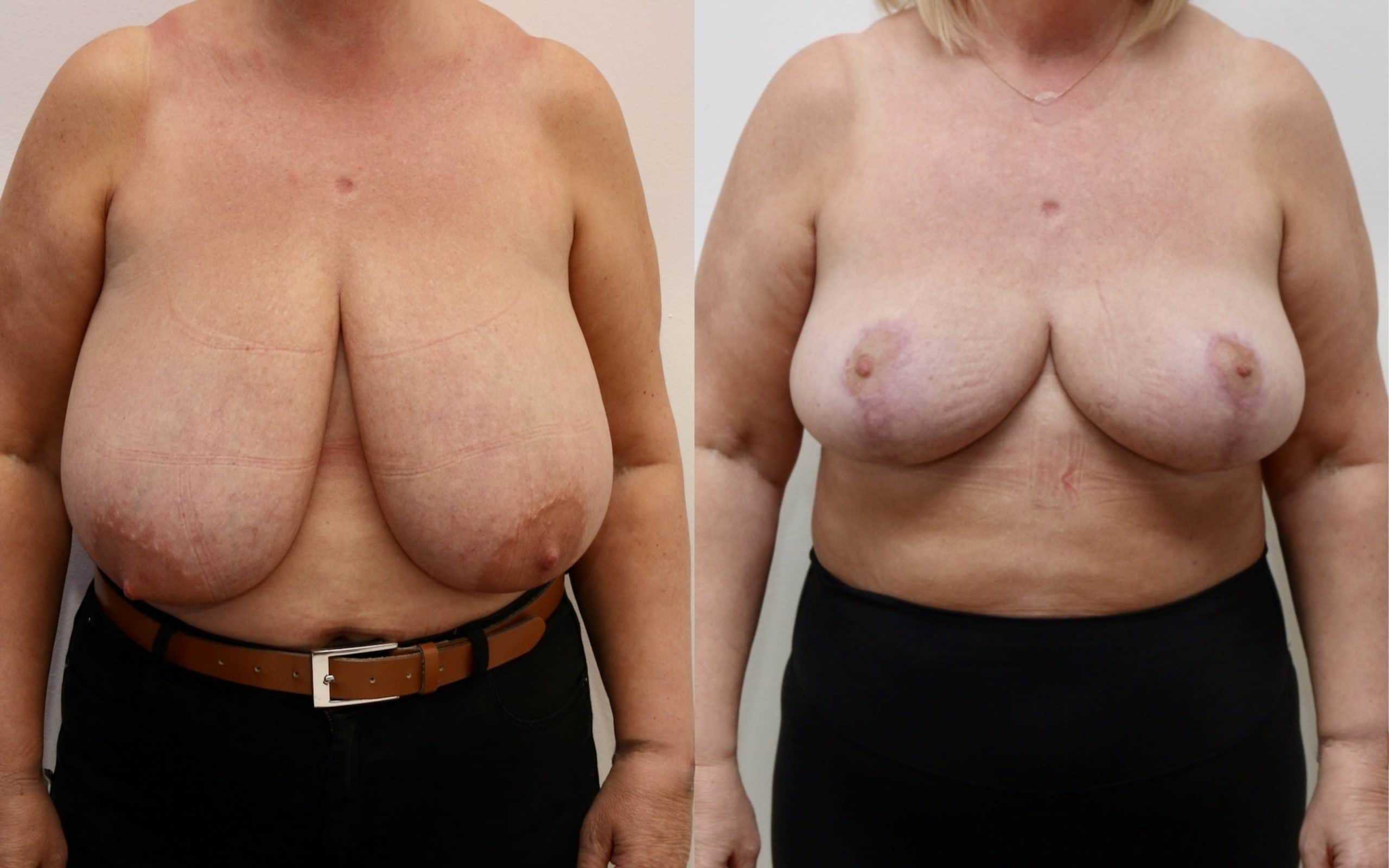 Large breast reduction