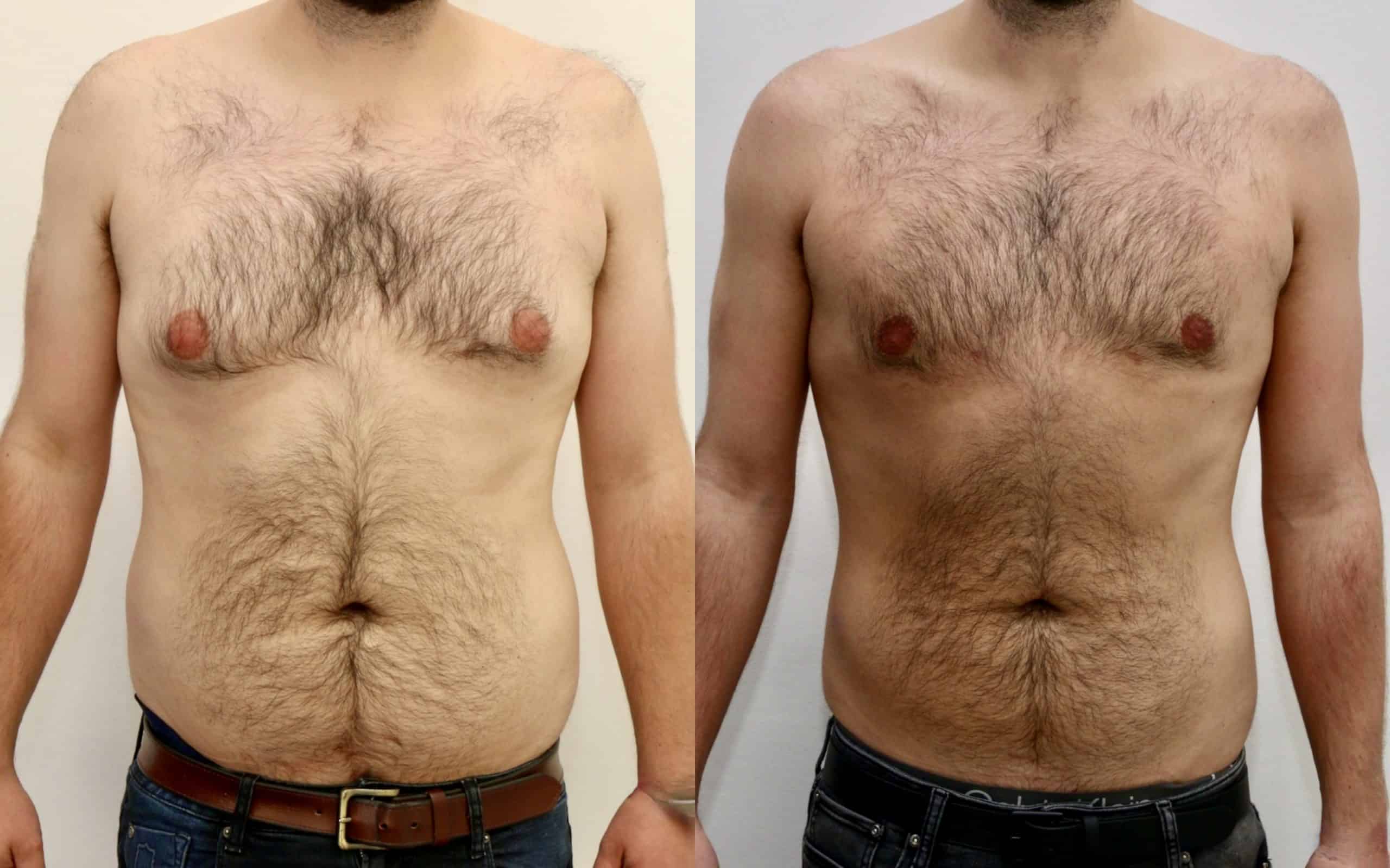 Gynecomastia before and after