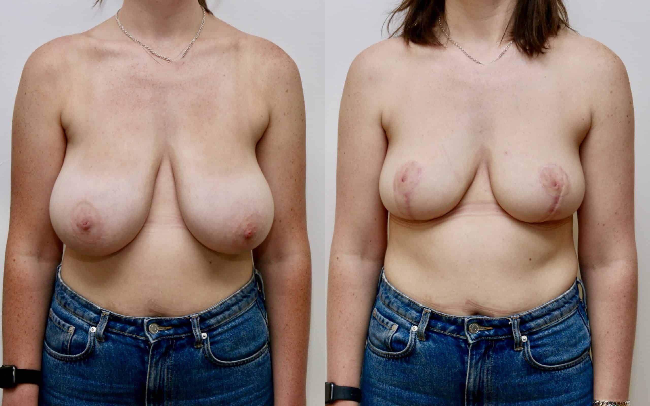 Breast reduction/ lift 6 months post-op
