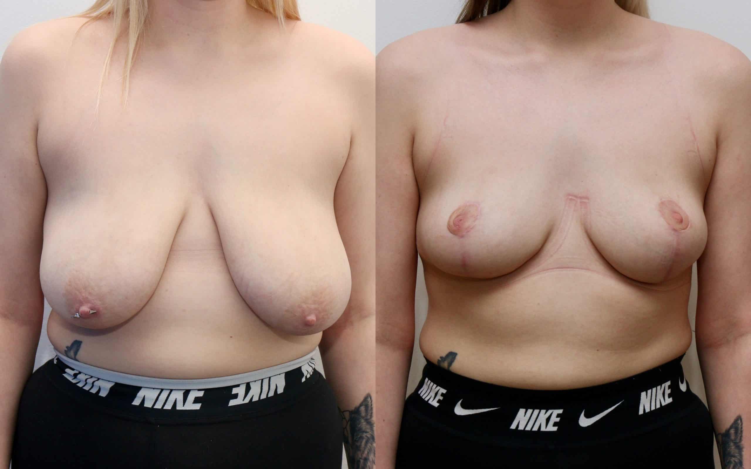 mastopexy before and after