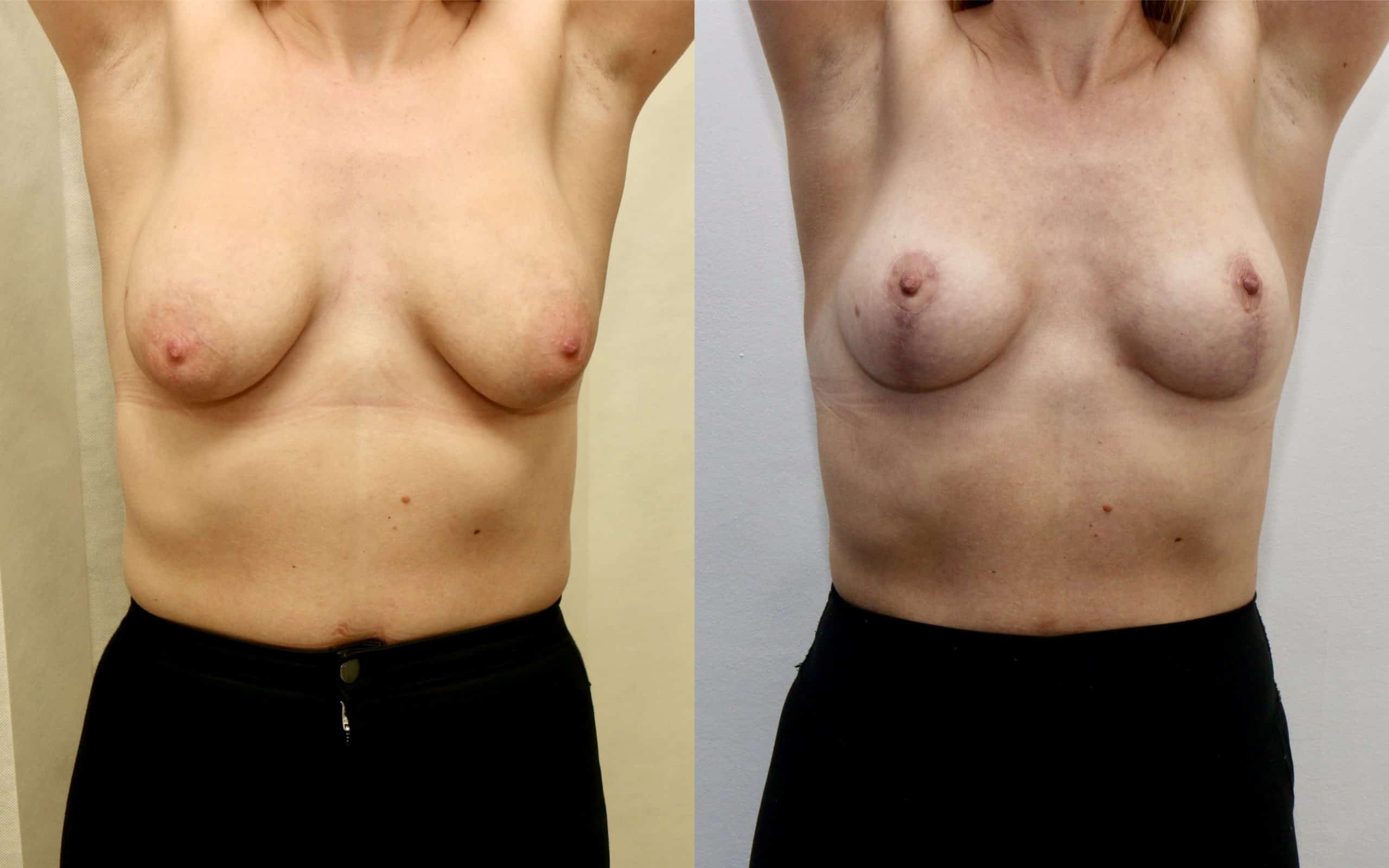 Breast lift (skin tightening only)