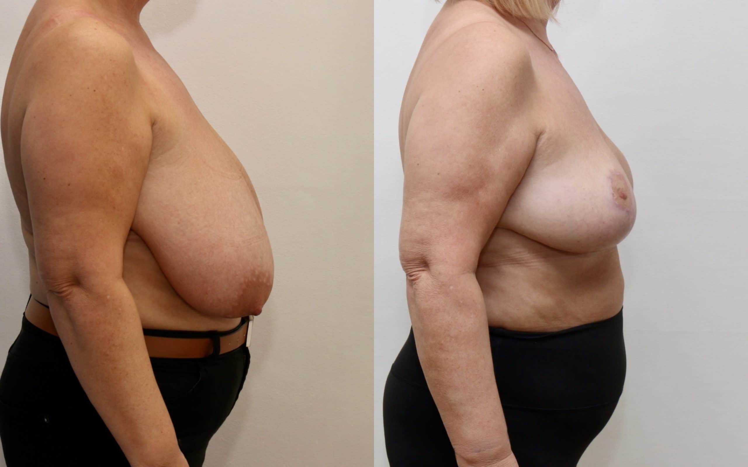 Large breast reduction