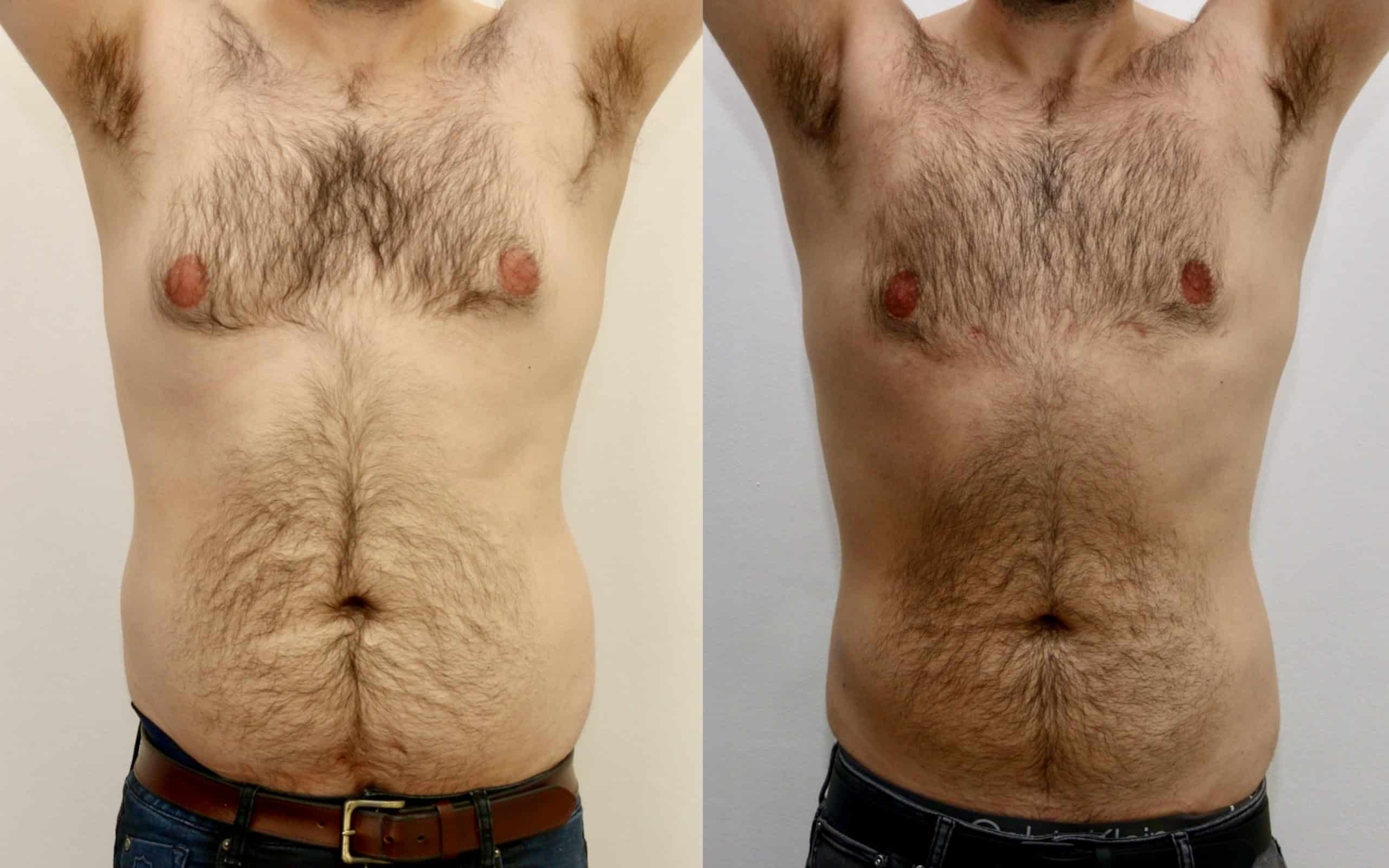 Gynecomastia before and after