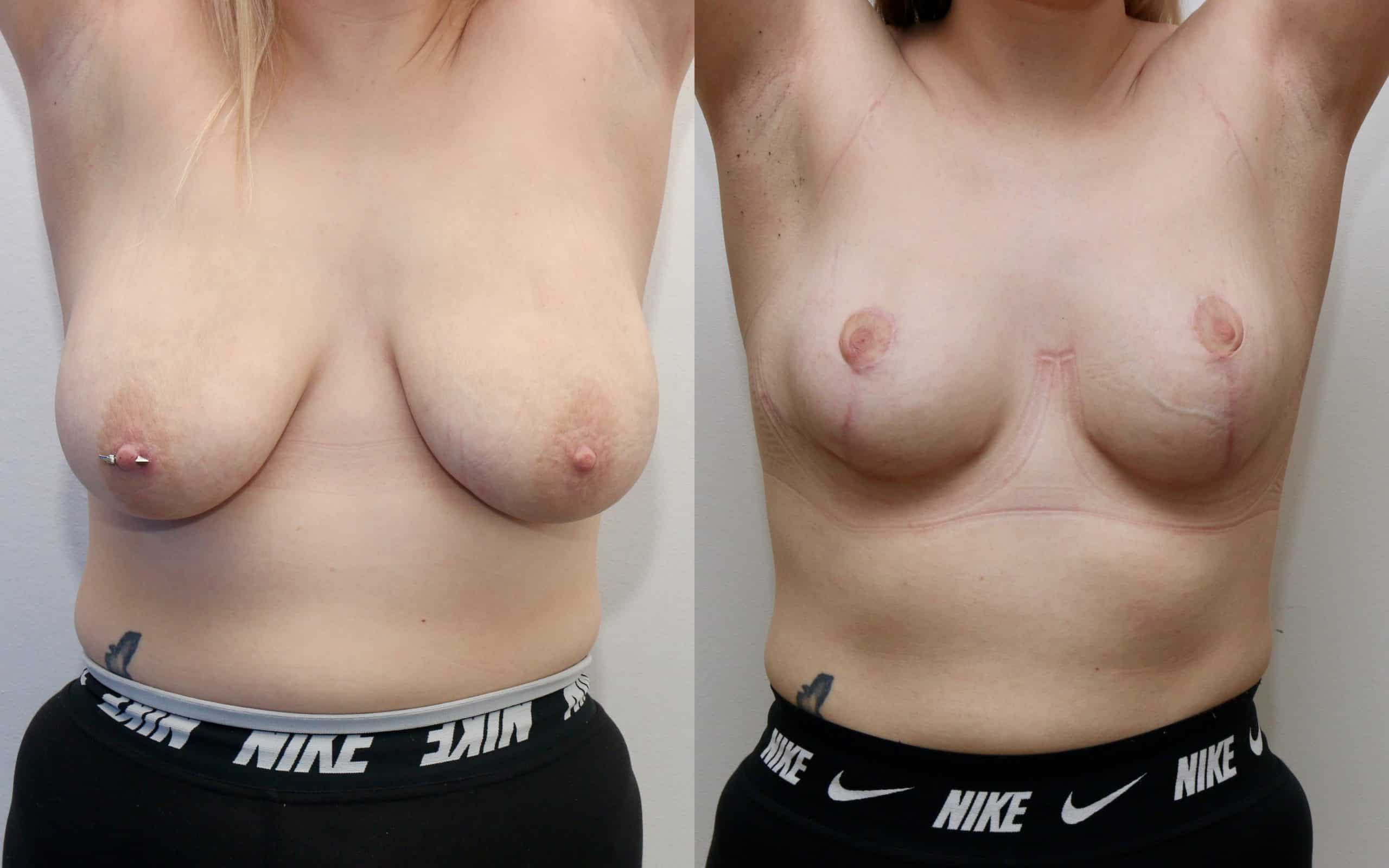 Breast lift with small reduction