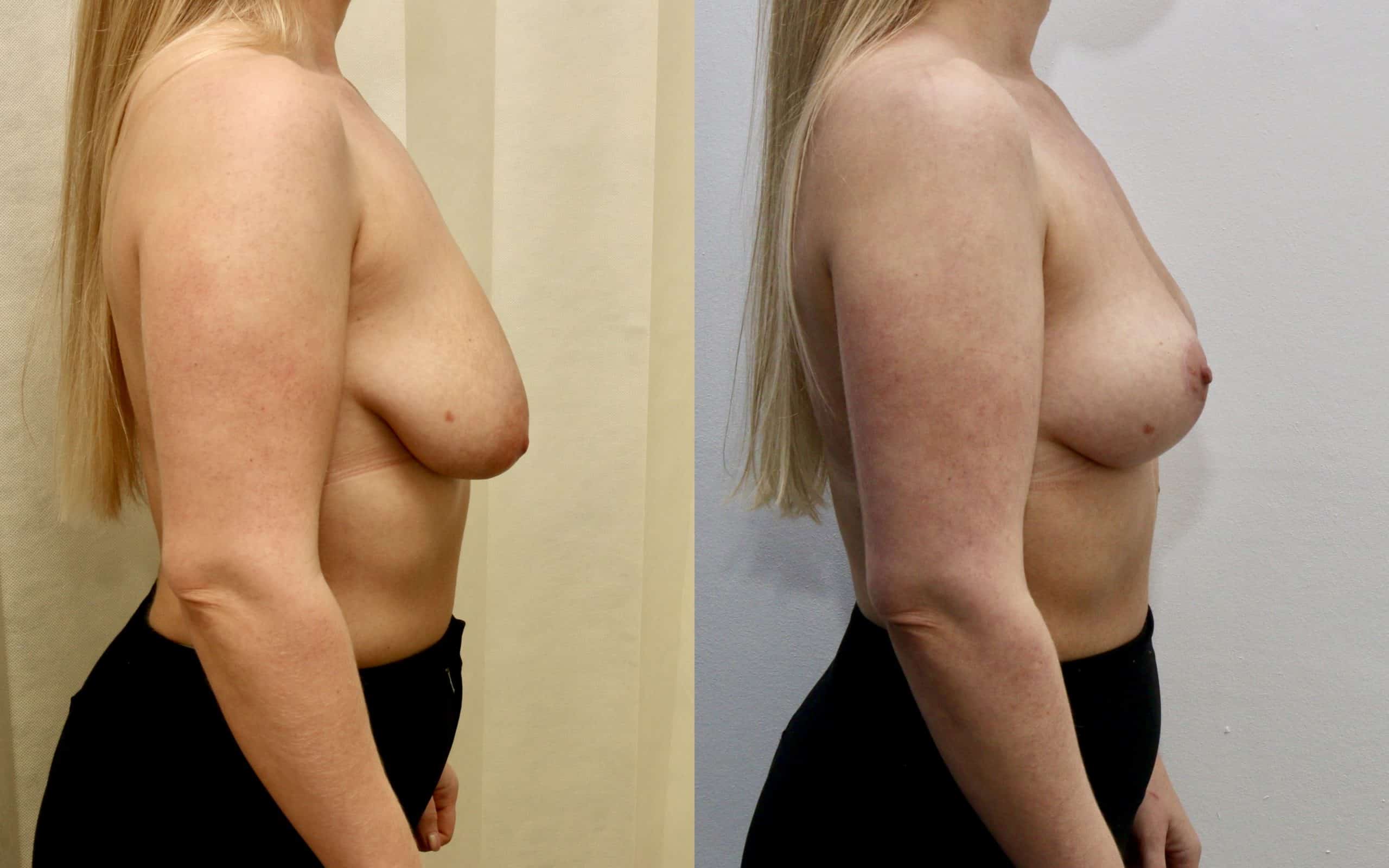 Breast lift (skin tightening only)