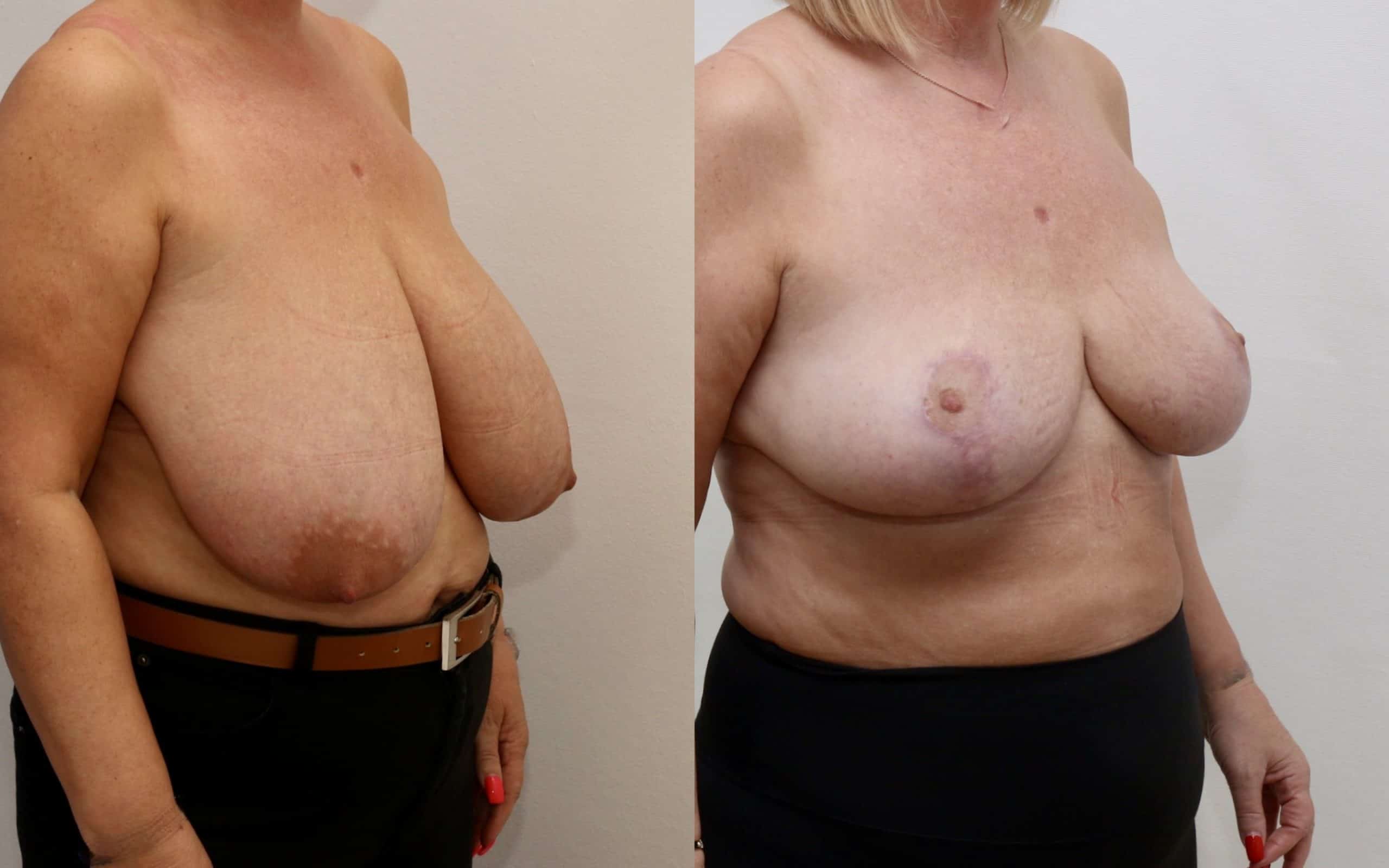 Large breast reduction