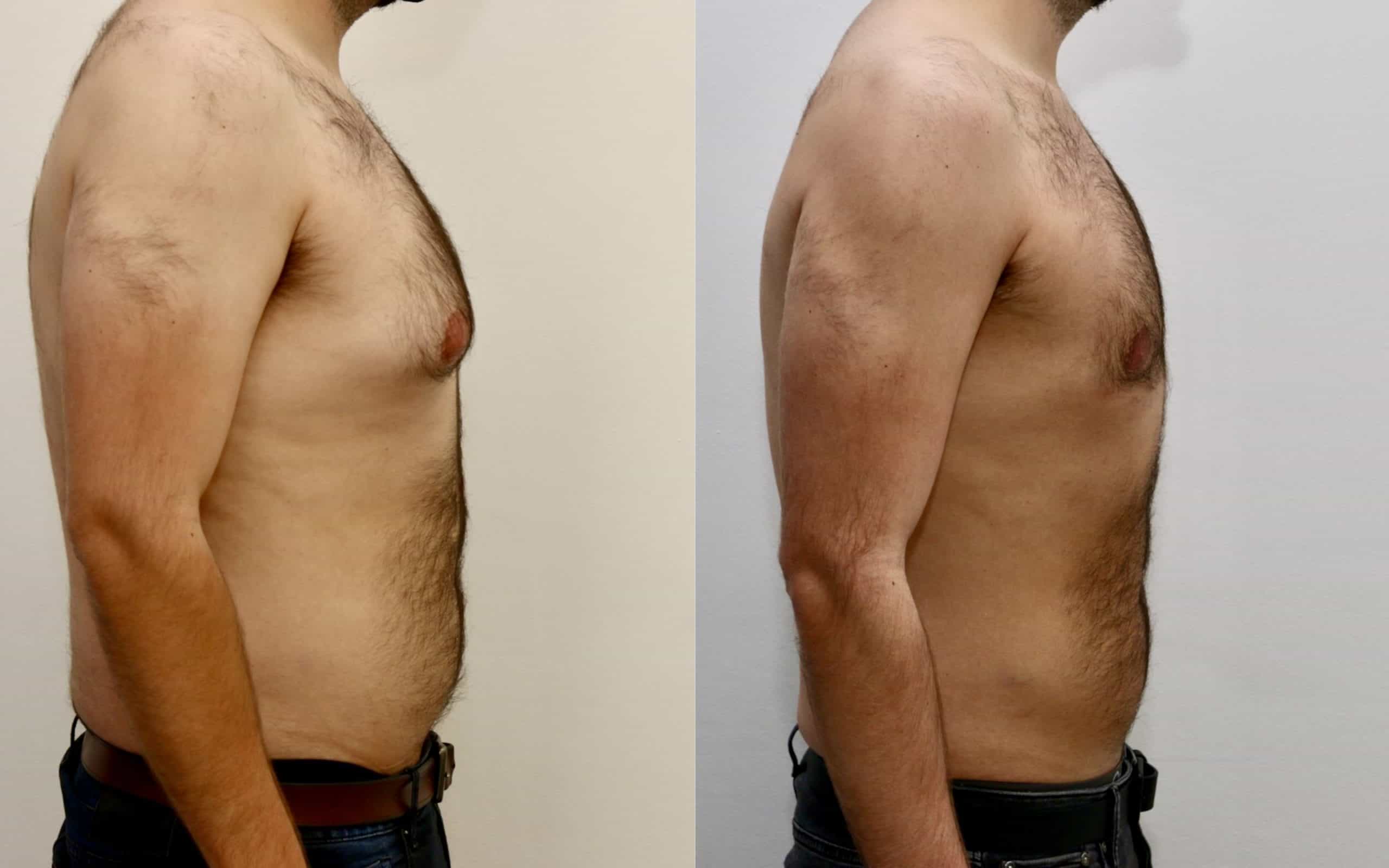 Gynecomastia before and after