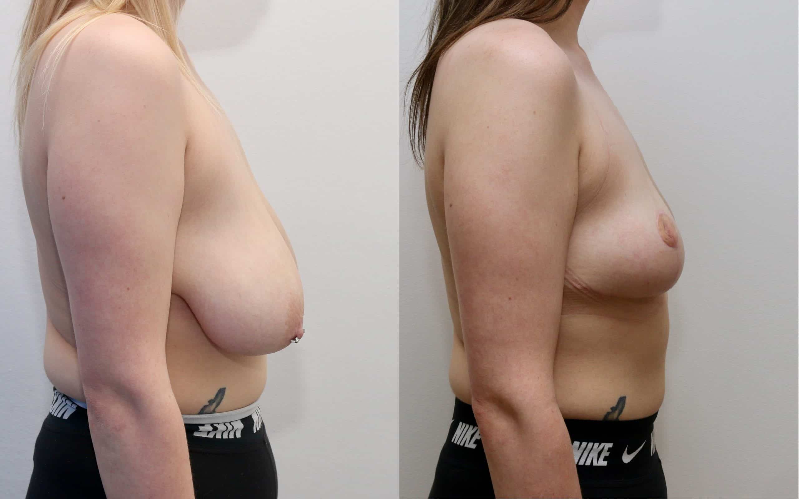 Breast lift with small reduction