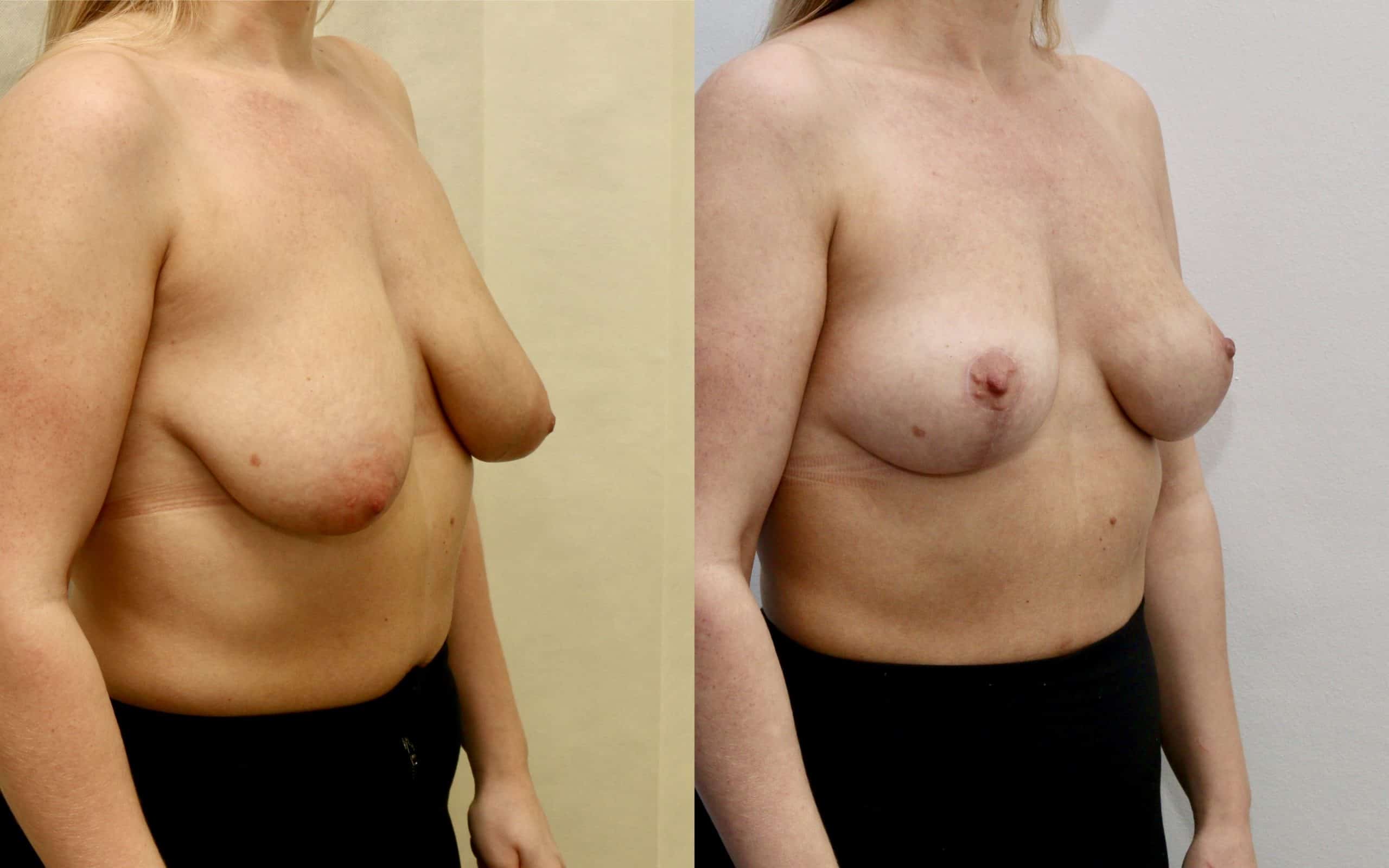 Breast lift (skin tightening only)