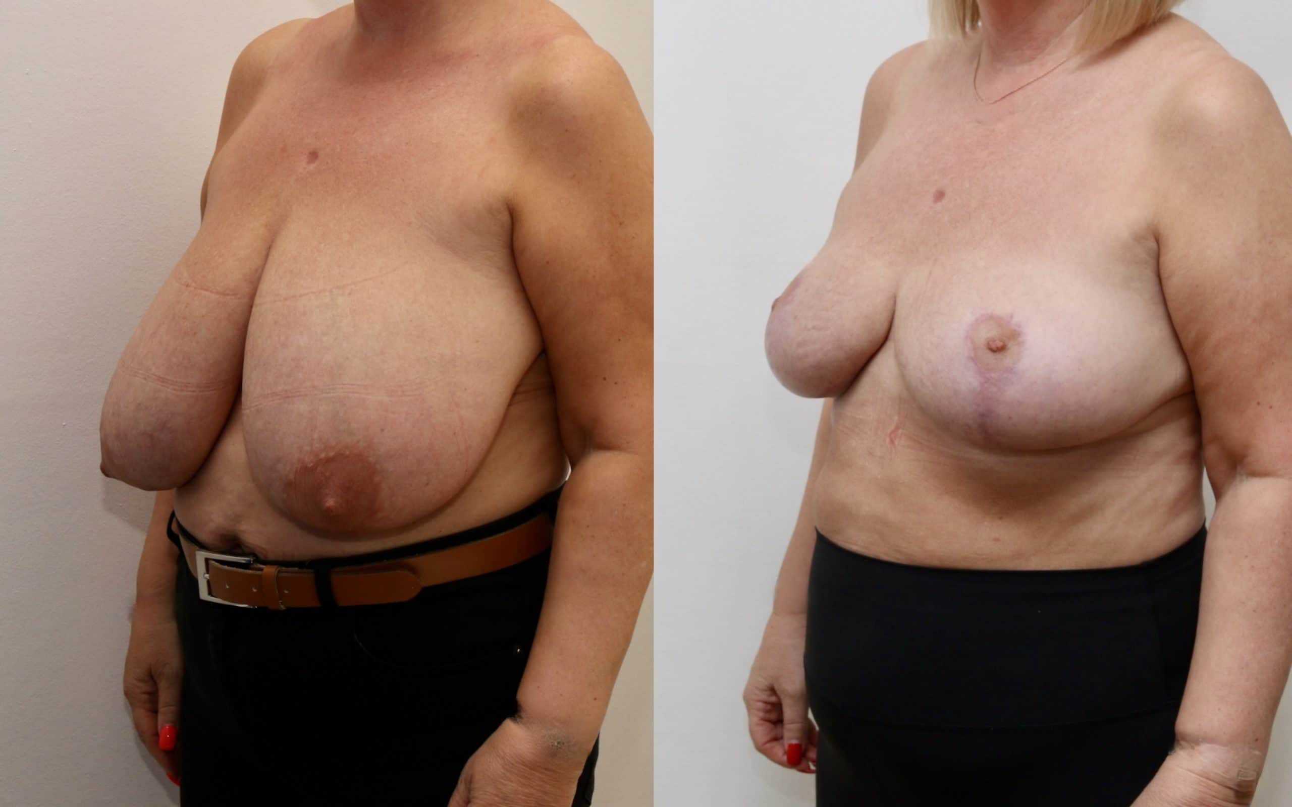 Large breast reduction