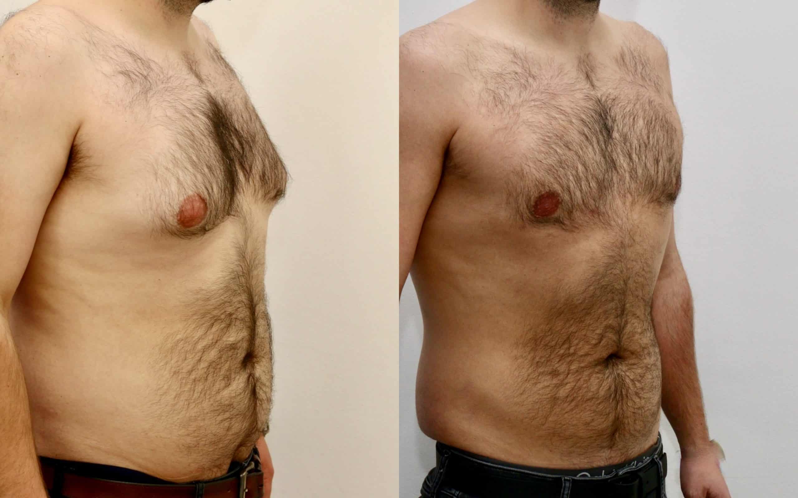 Gynecomastia before and after