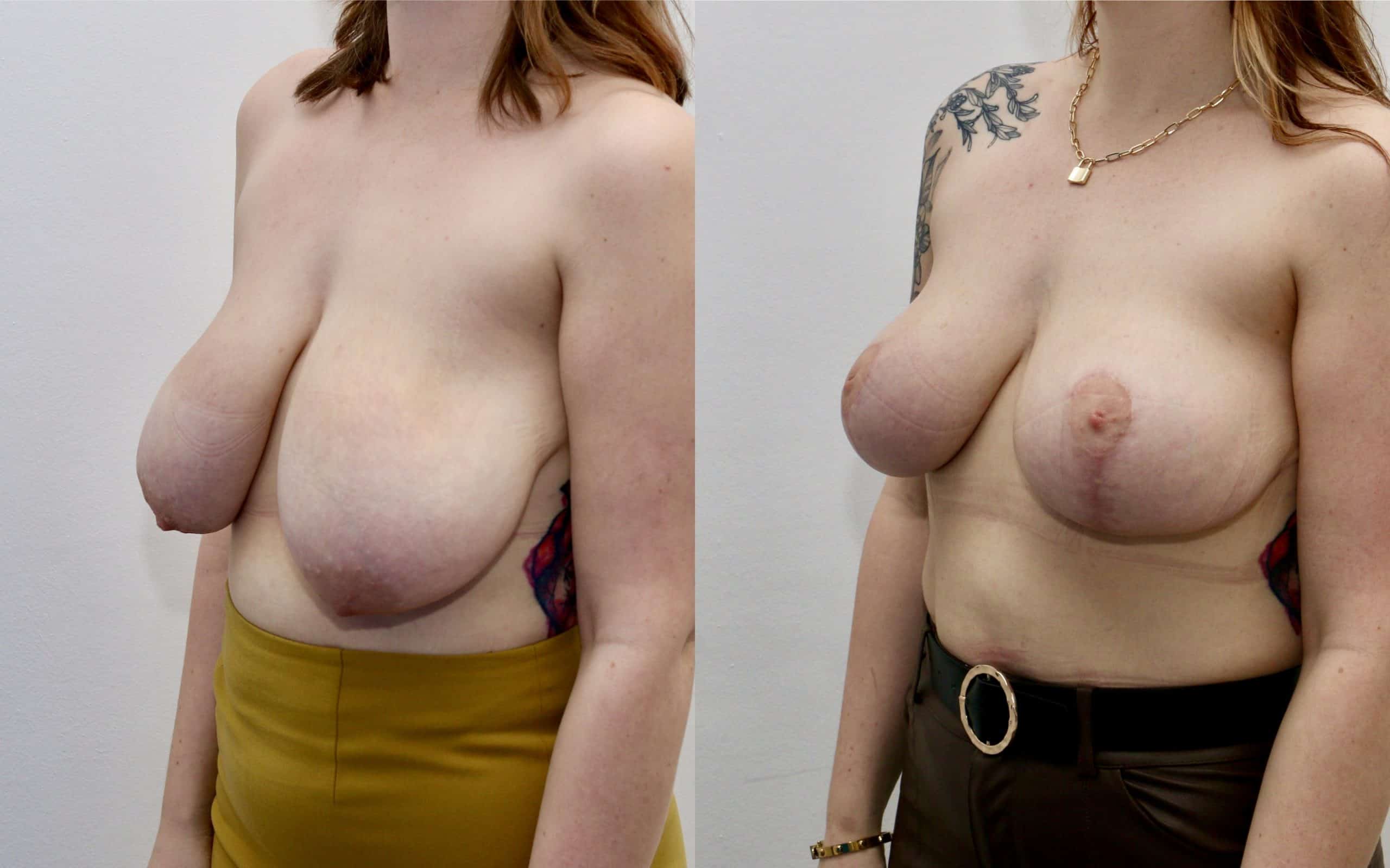 Breast lift