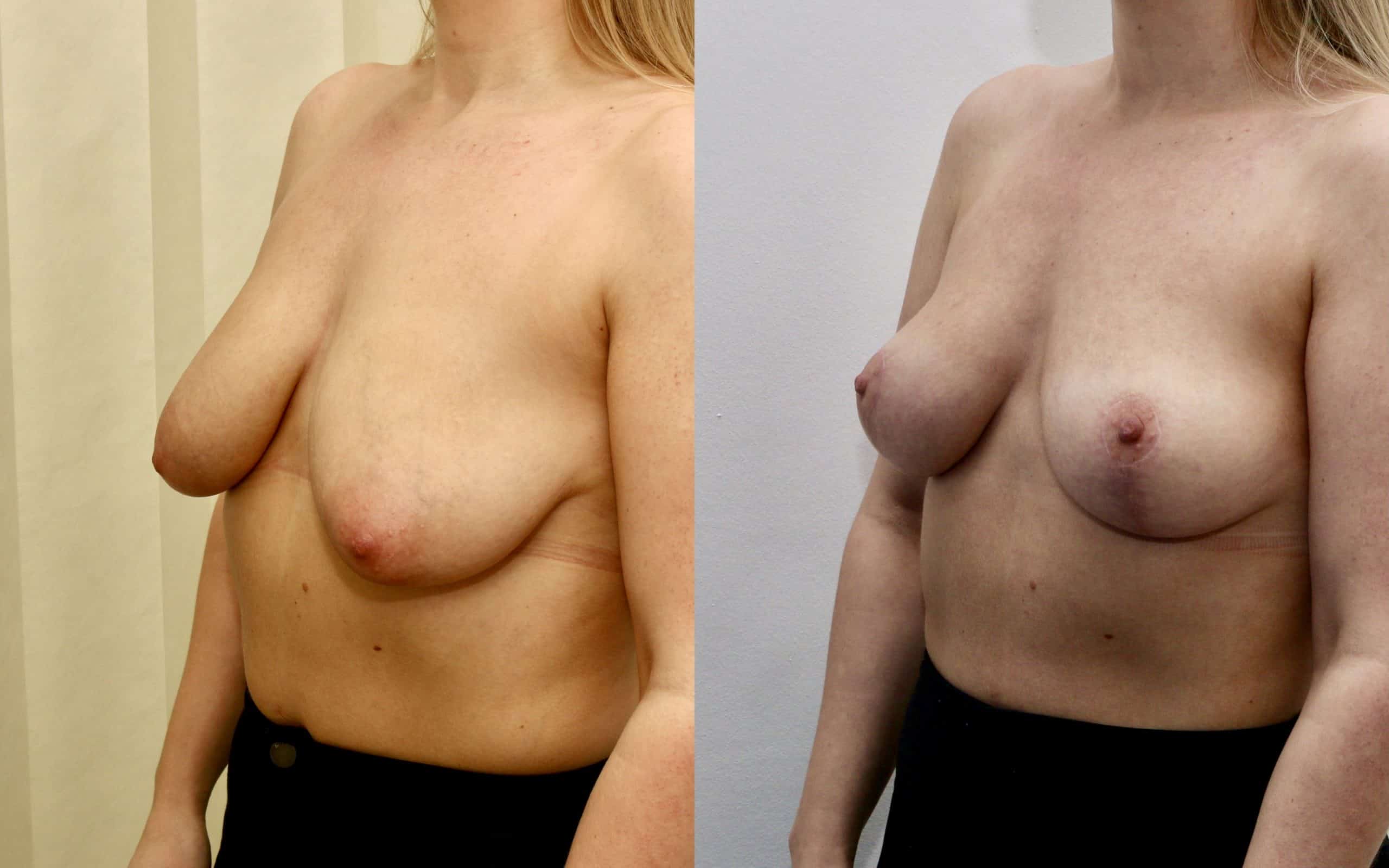 Breast lift (skin tightening only)