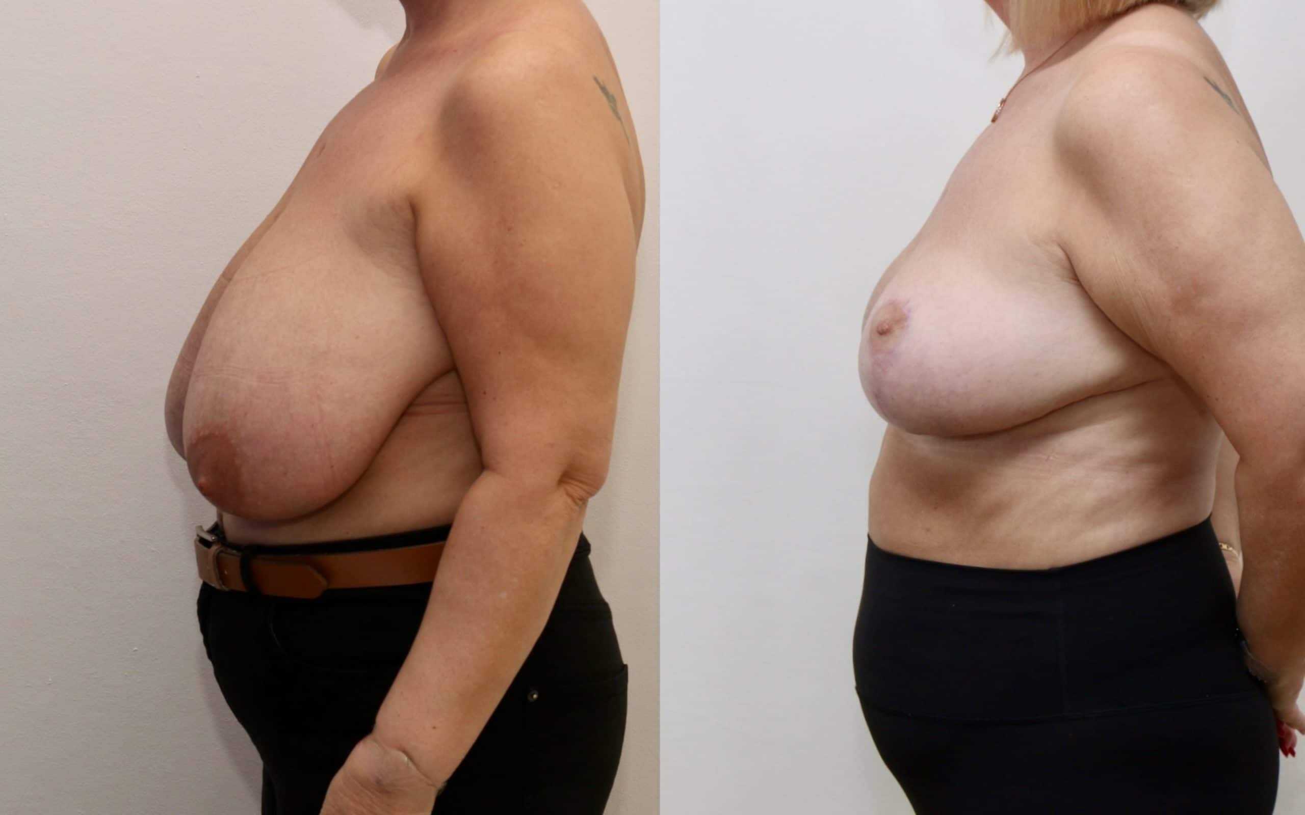 Large breast reduction