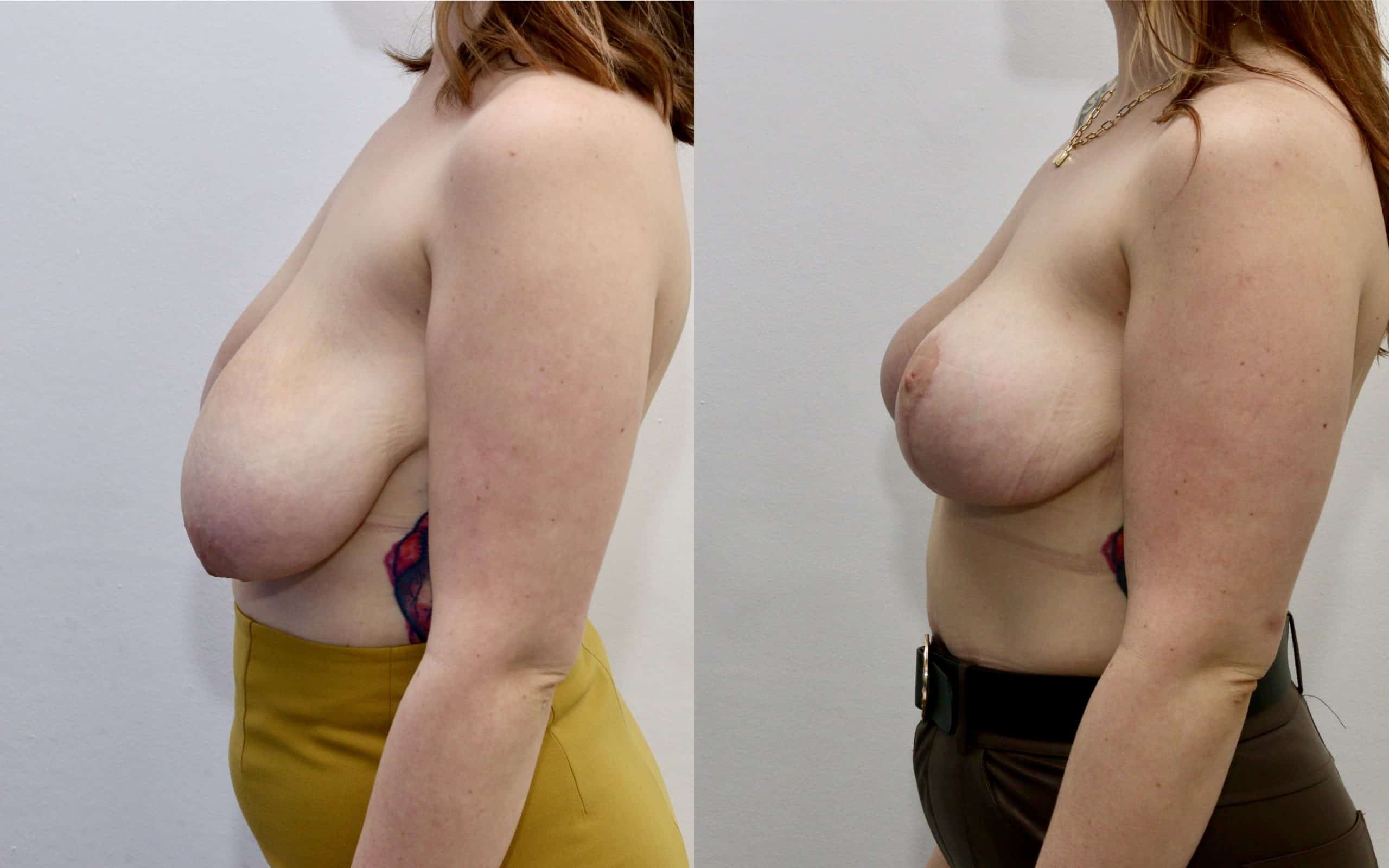 Breast lift