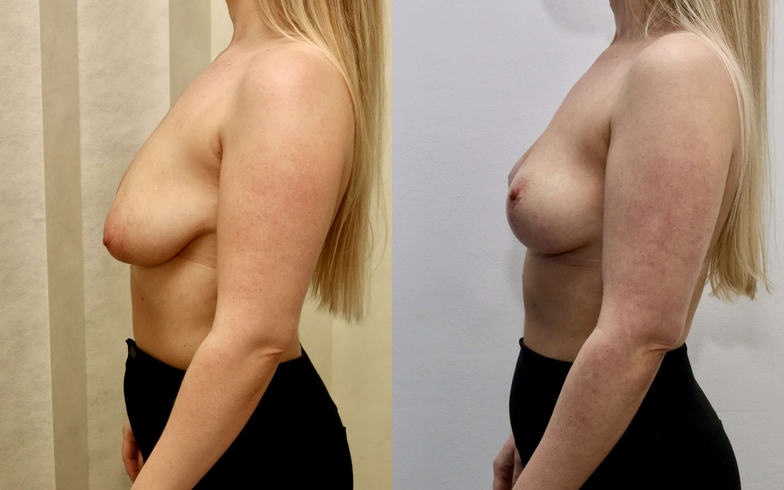 Breast lift (skin tightening only)