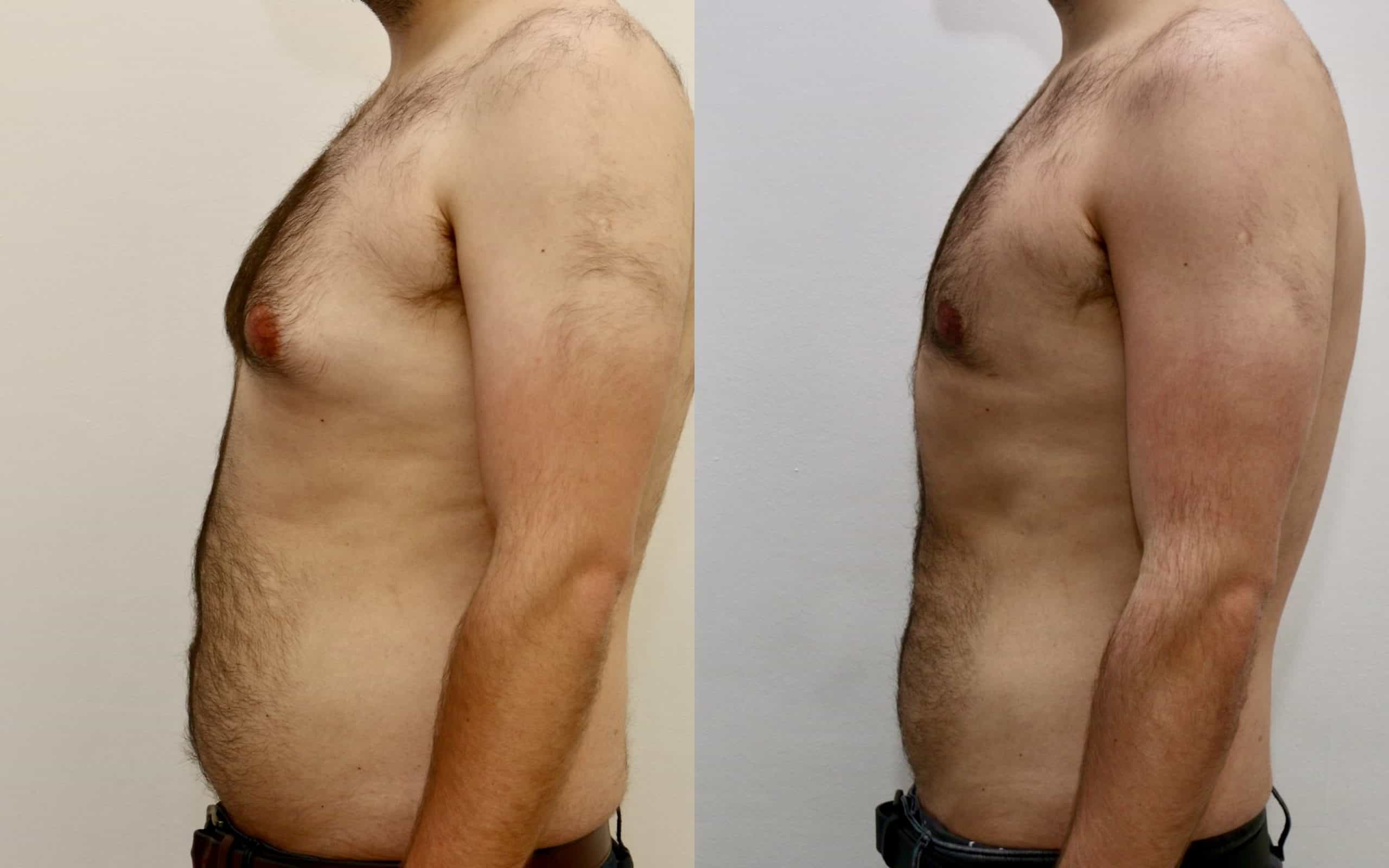 Gynecomastia before and after