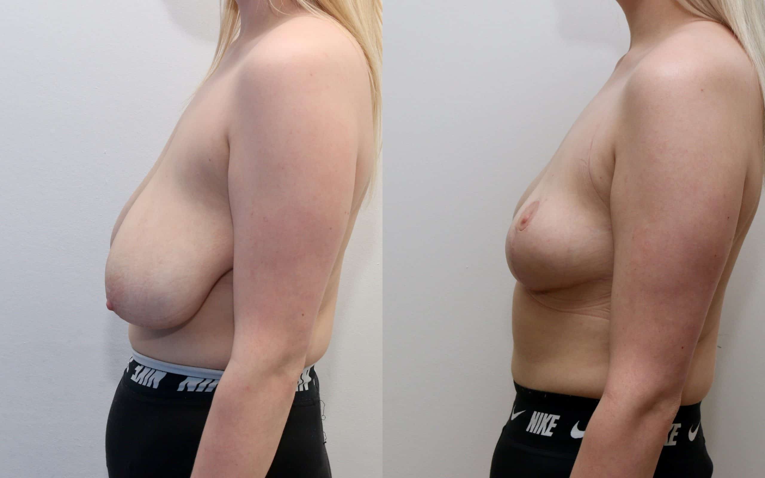 Breast lift with small reduction