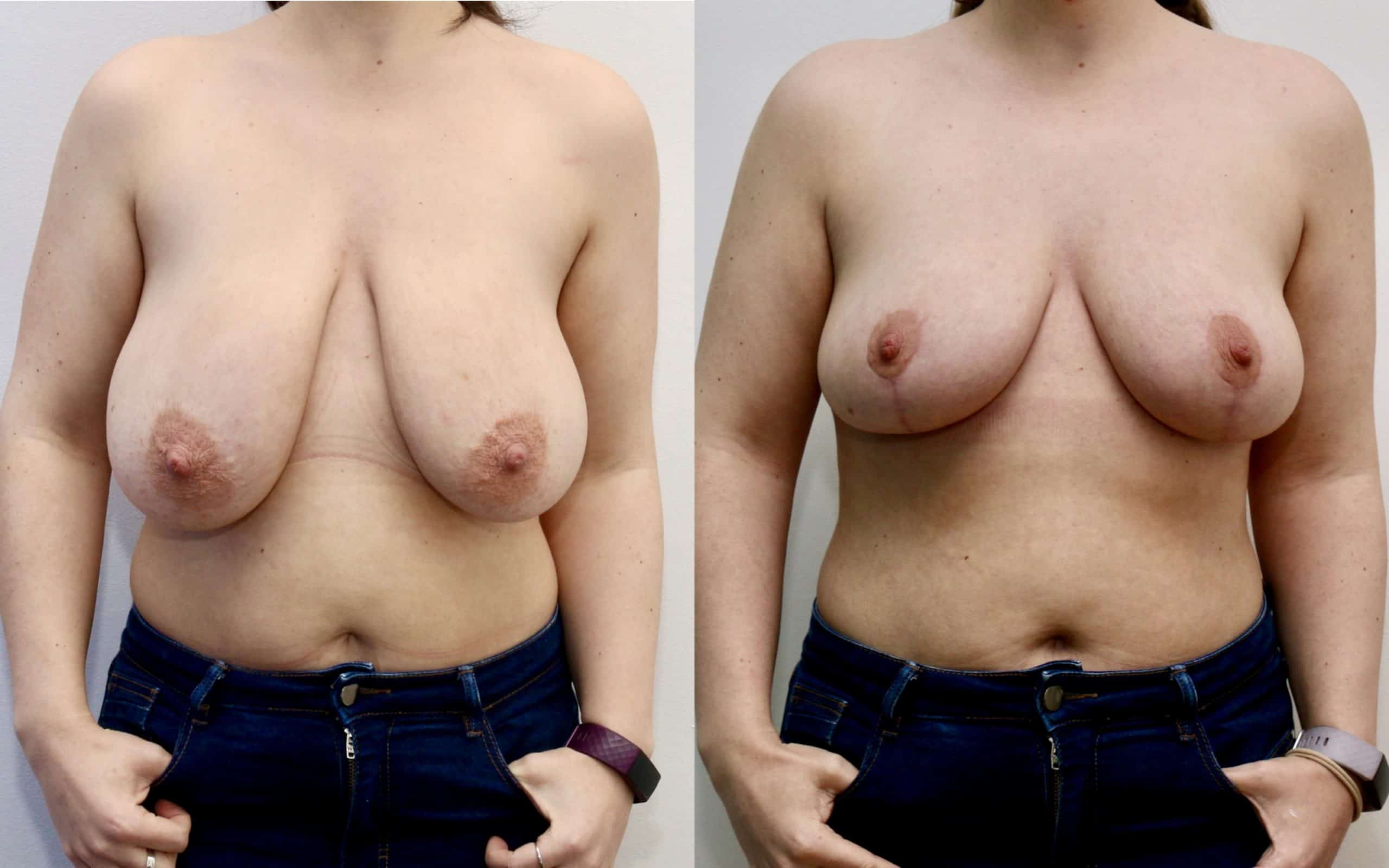 breast uplift scotland