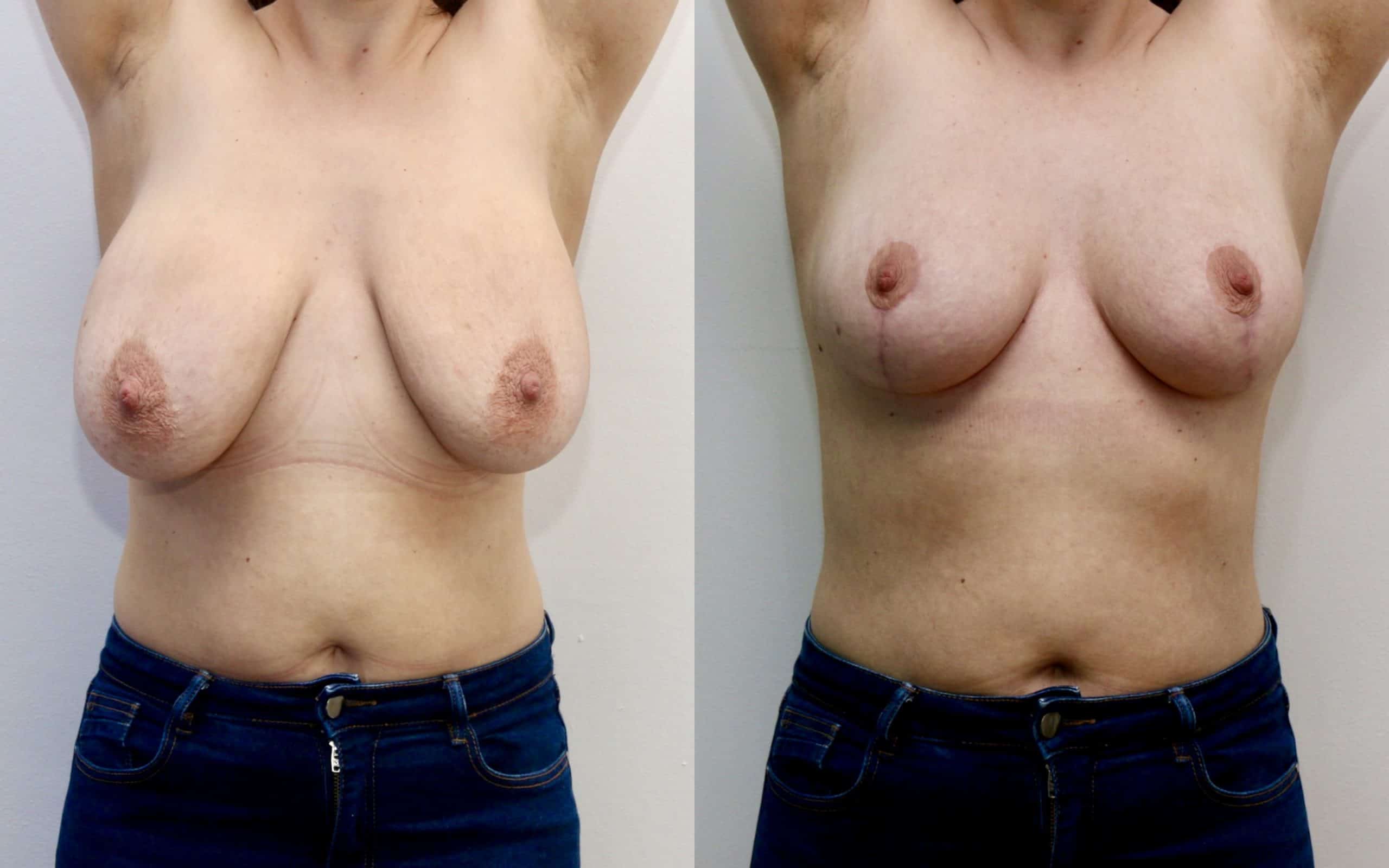 Breast uplift with small reduction