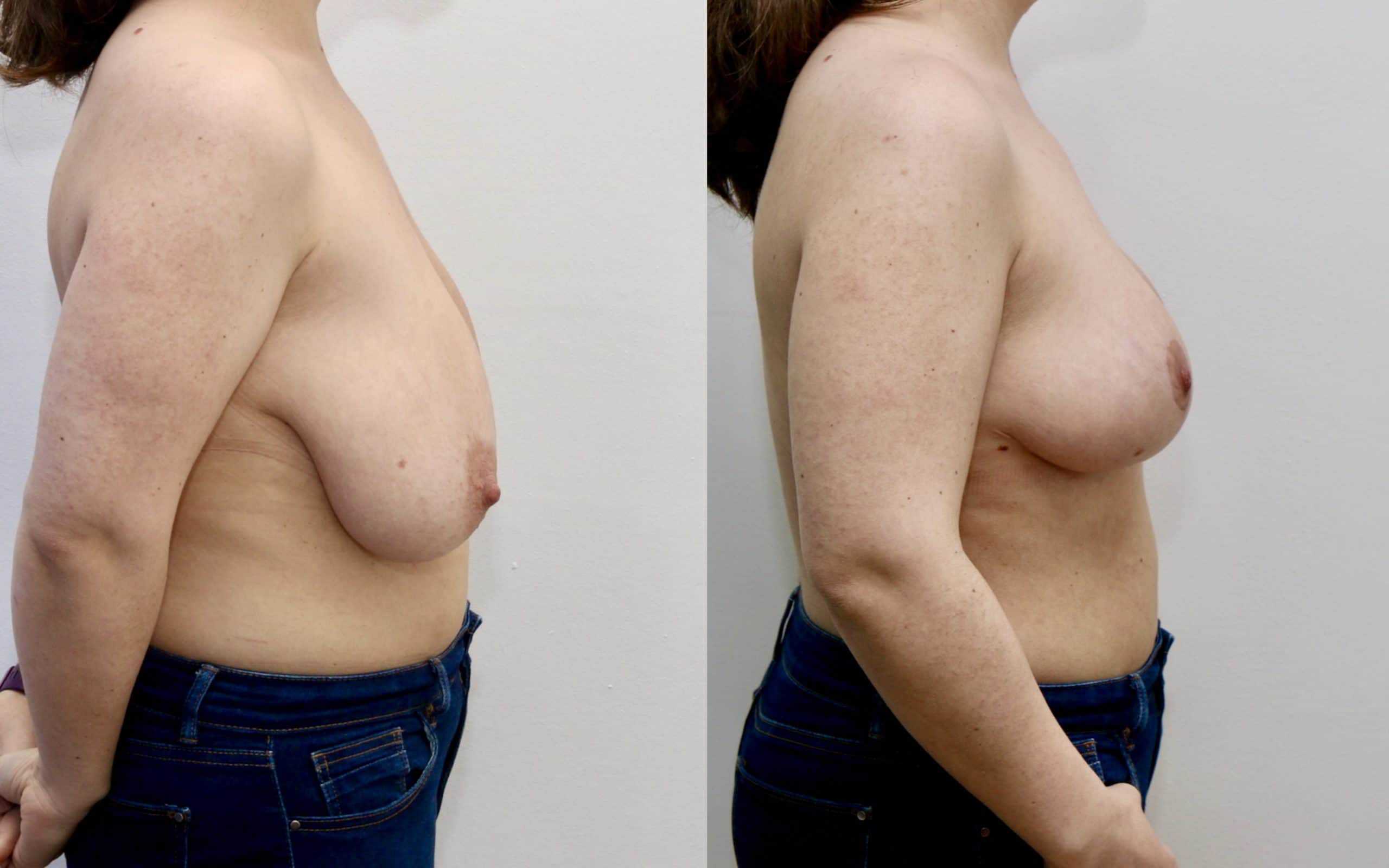 breast uplift edinburgh