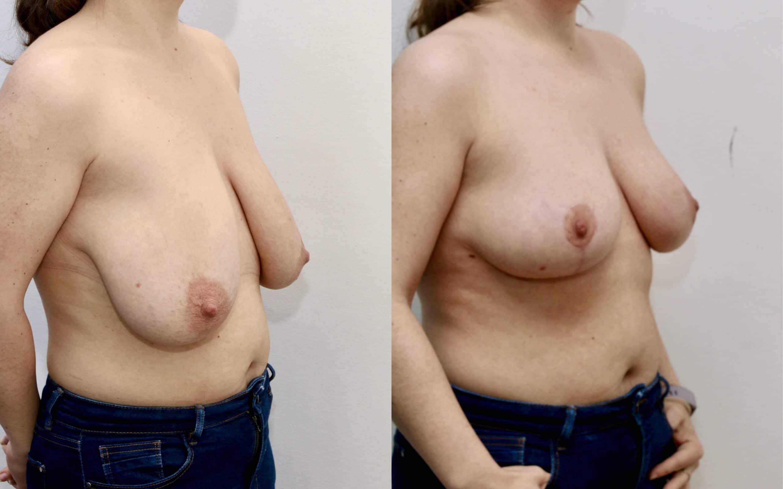 Breast uplift with small reduction