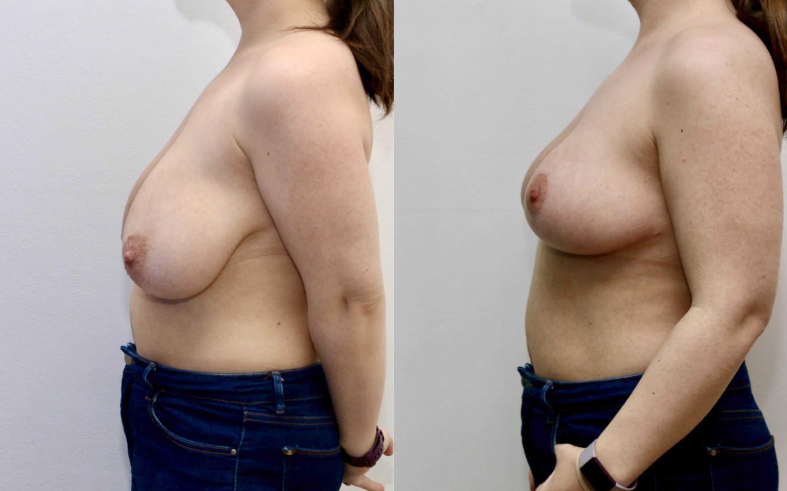 Breast uplift with small reduction