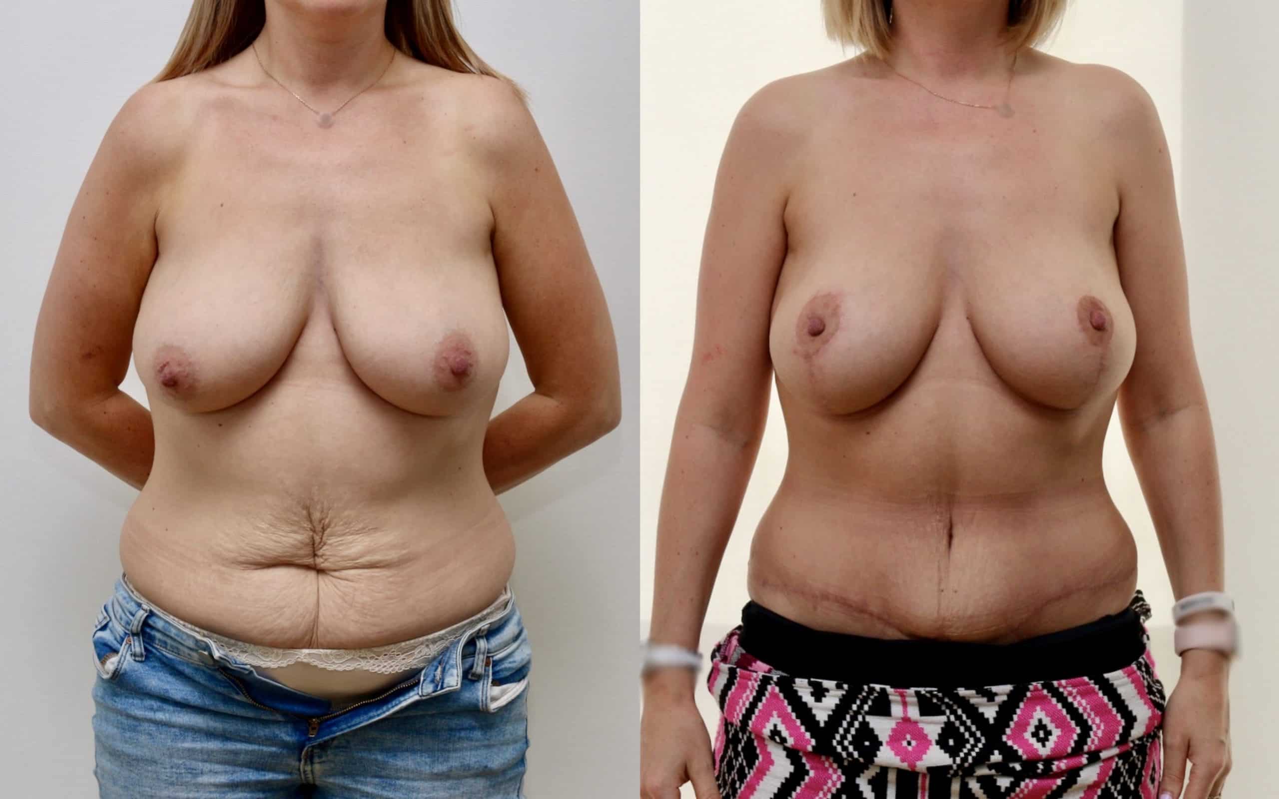 Breast list with implants and full tummy tuck
