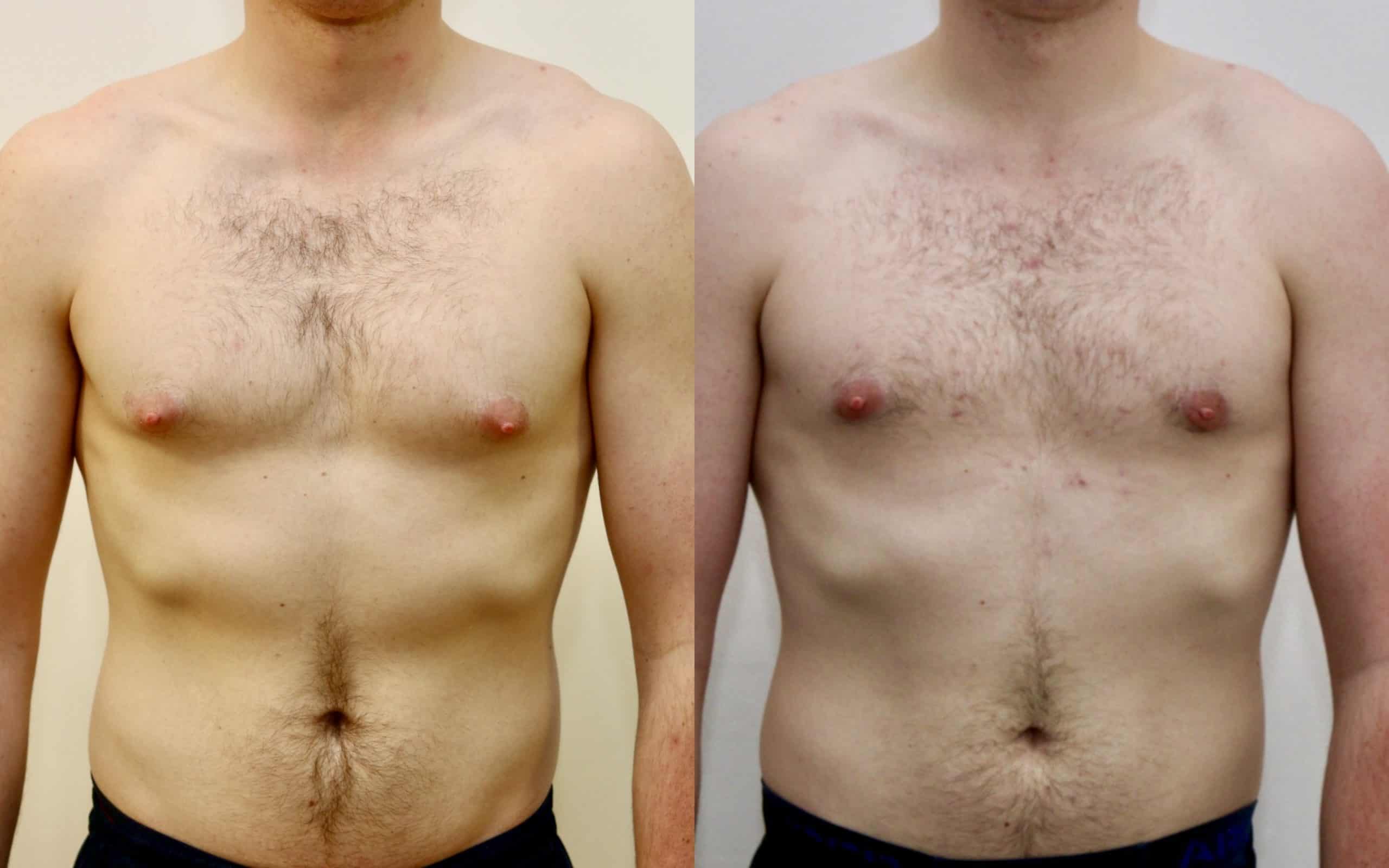 Gynecomastia liposuction and gland excision before and after