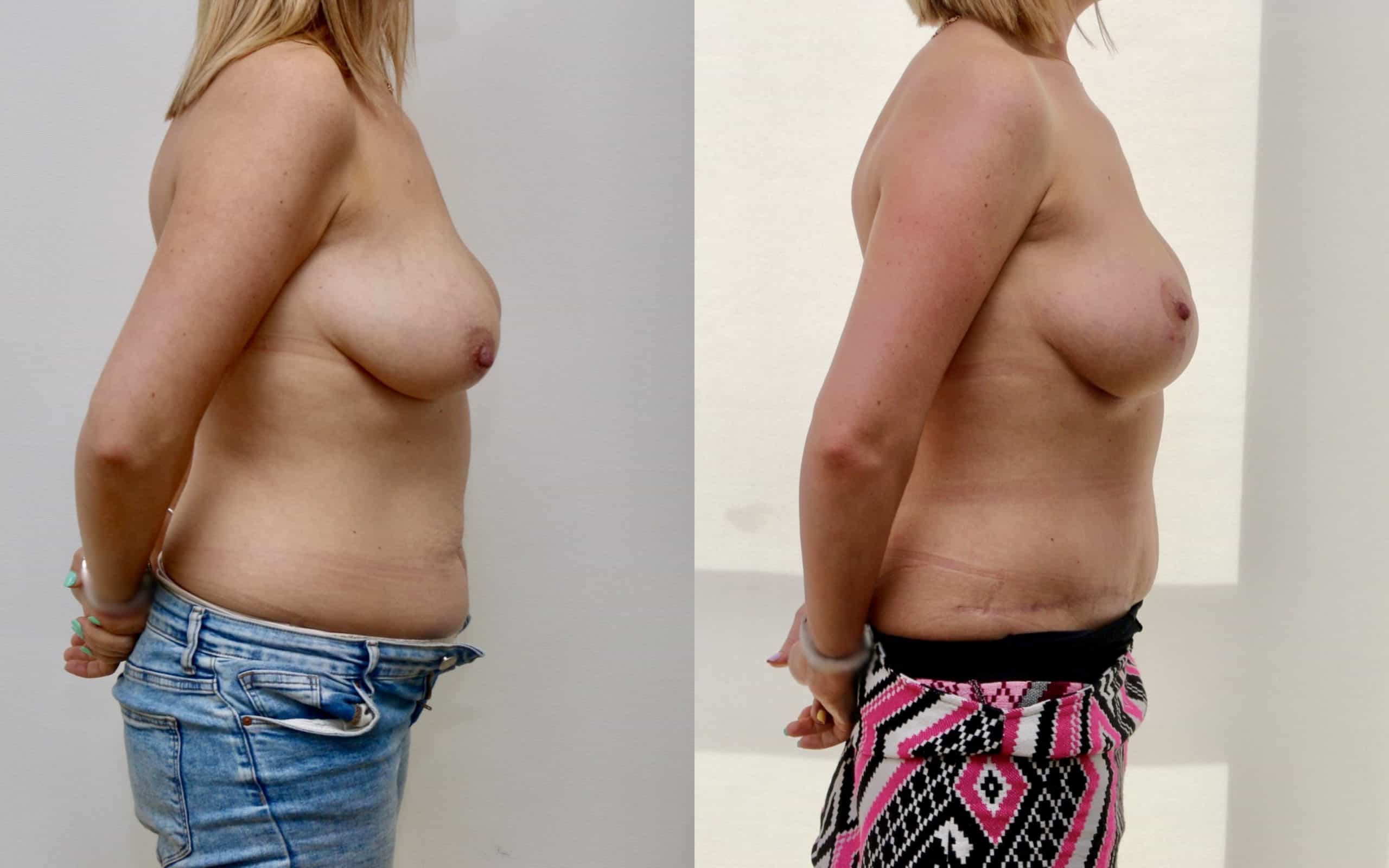 Tummy tuck and breast lift