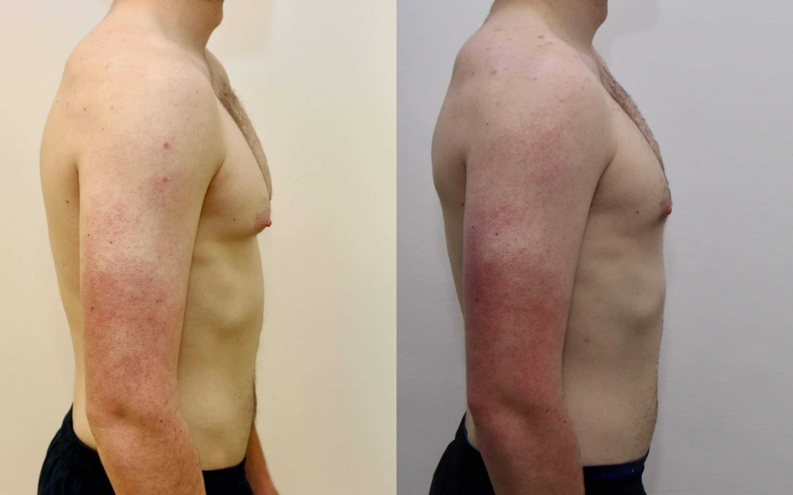 Gynecomastia liposuction and gland excision before and after