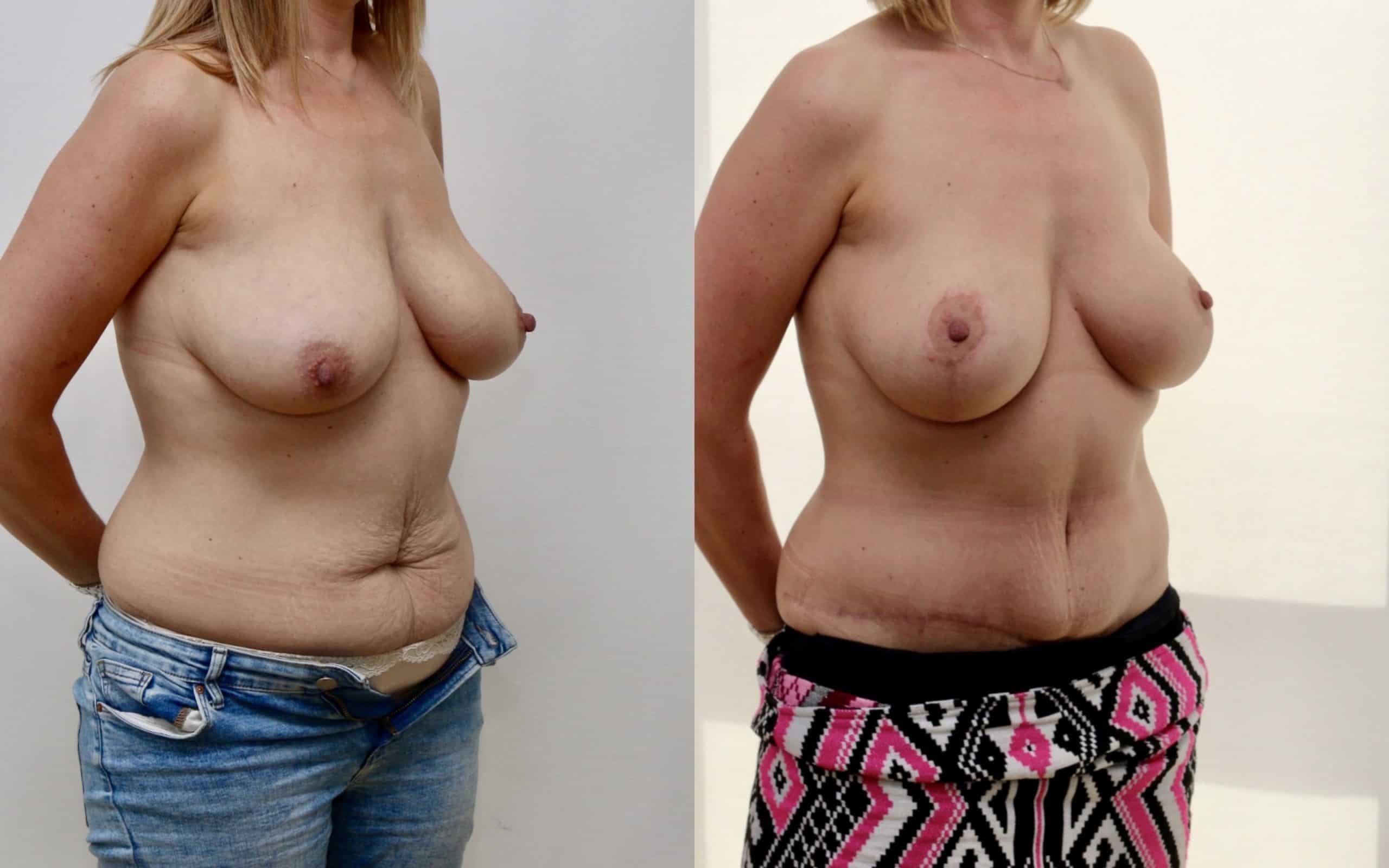 Breast list with implants and full tummy tuck