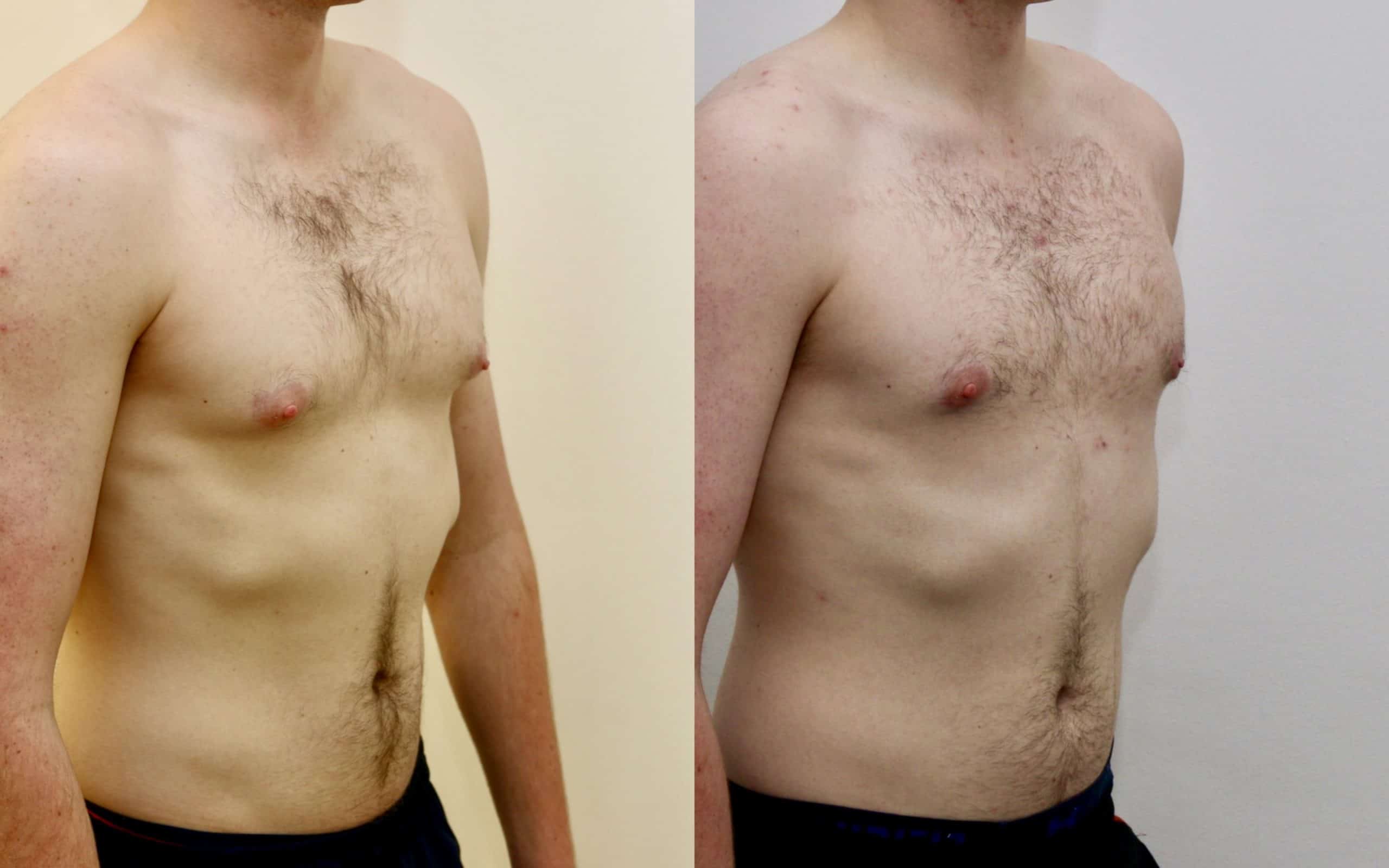 Gynecomastia liposuction and gland excision before and after
